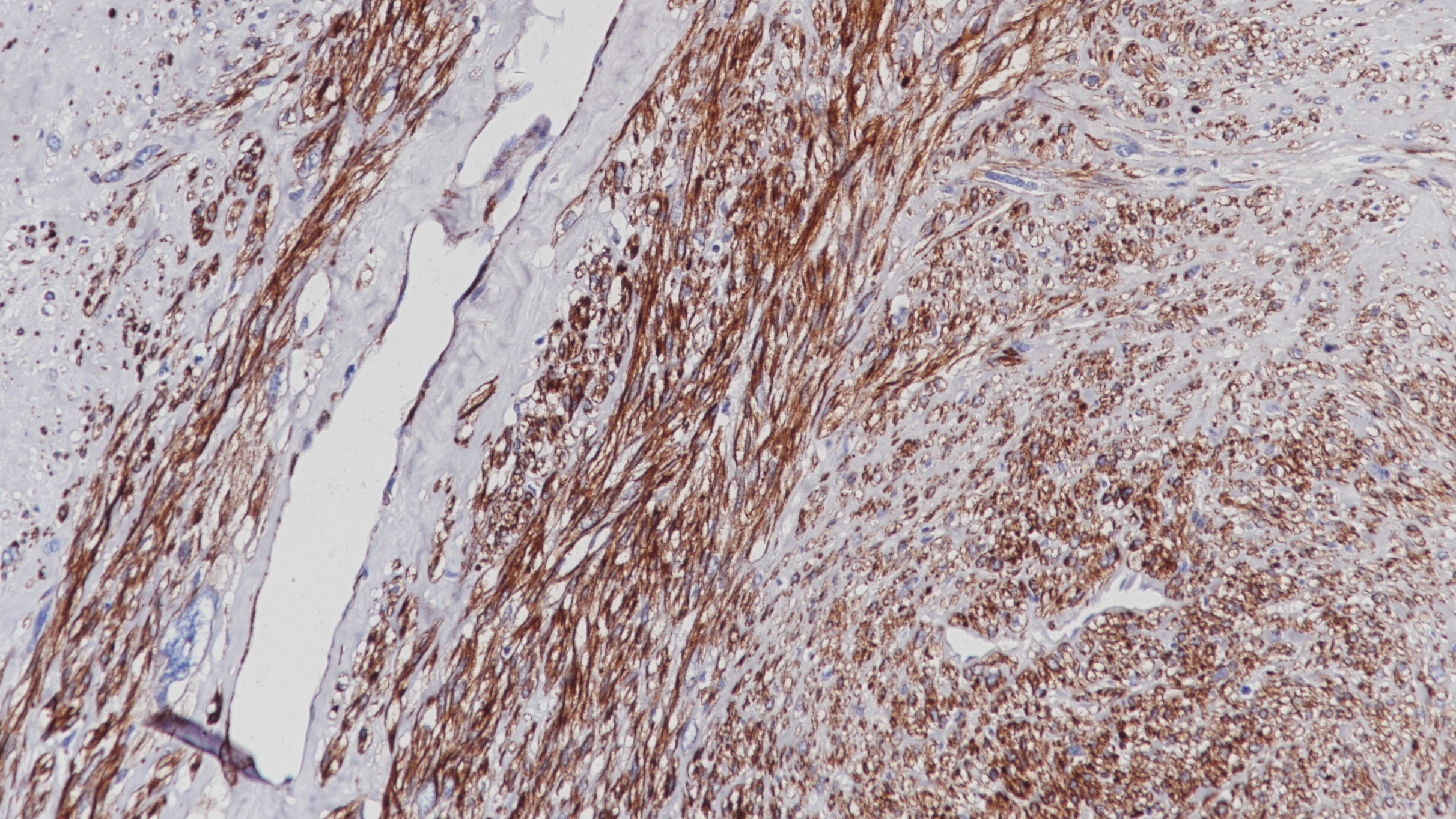 平滑肌肉瘤MSA(SC28)染色