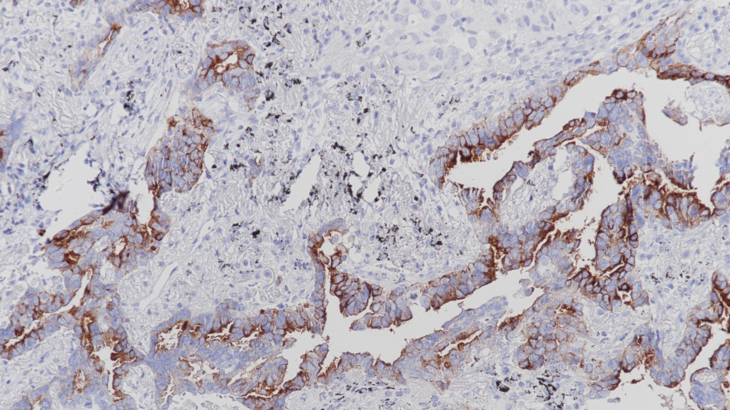 肺腺癌MUC4(BP6121)染色