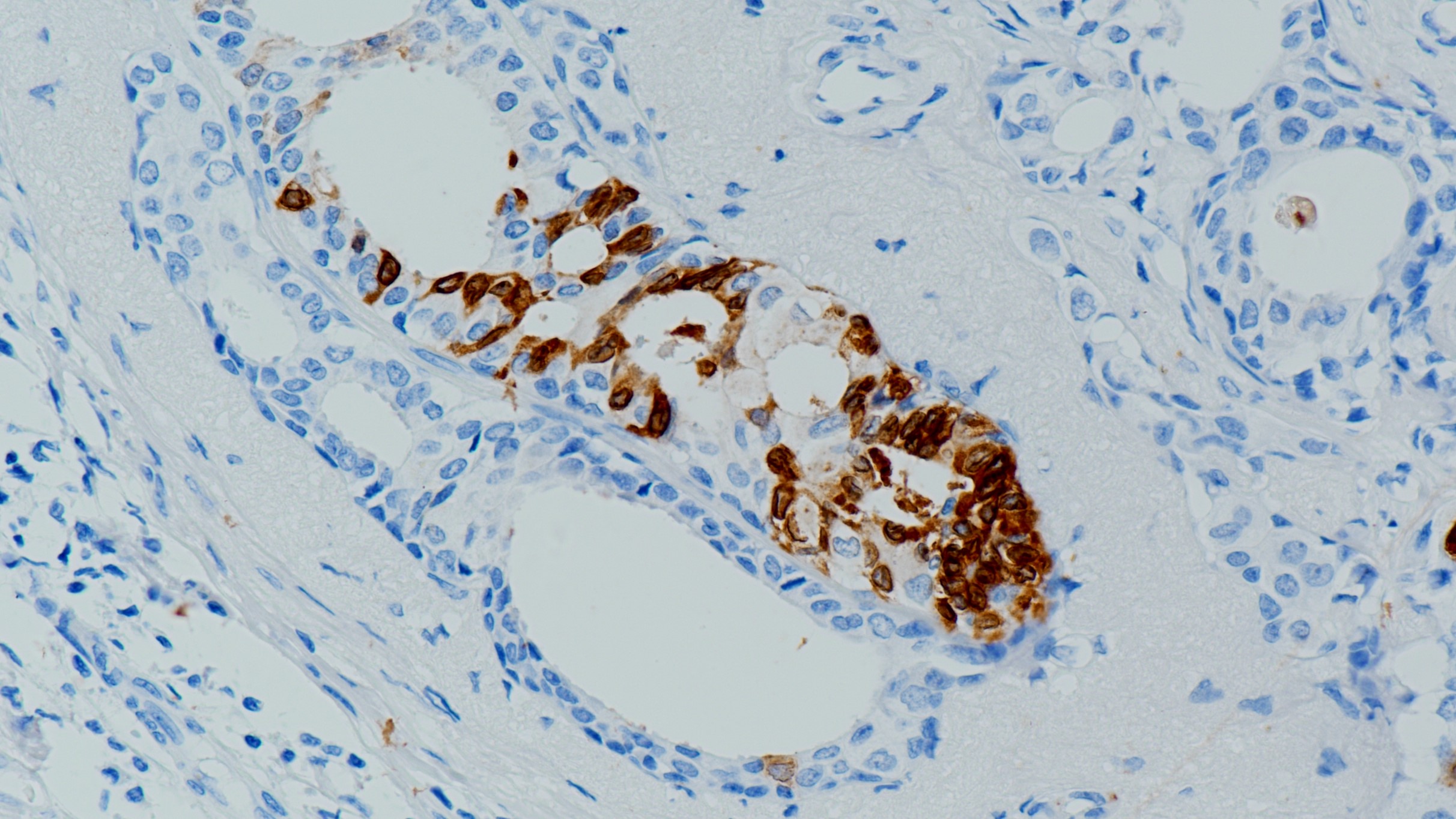 乳腺癌Mammaglobin(BP6125)染色.jpg