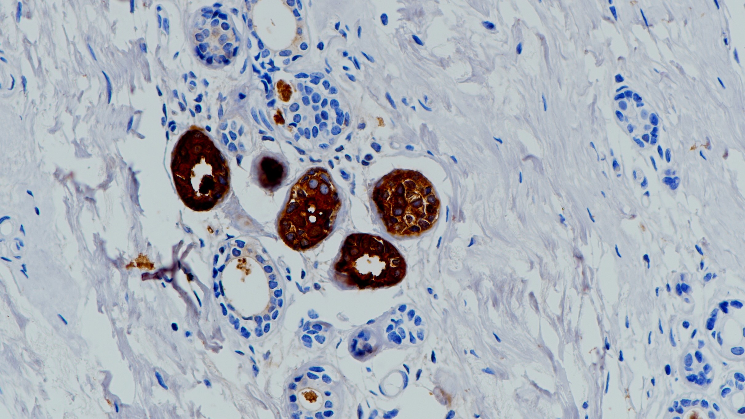 乳腺GCDFP-15(BP6118)染色