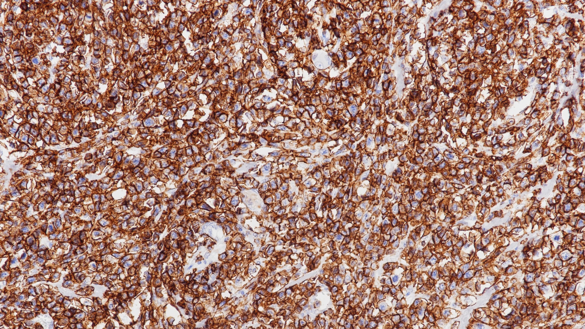 细胞淋巴瘤CD43(DF-T1)染色