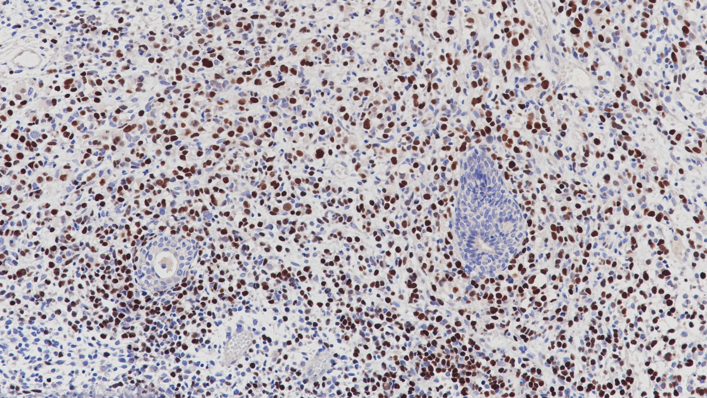 胚胎型横纹肌肉瘤Myo D1(BP6124)染色