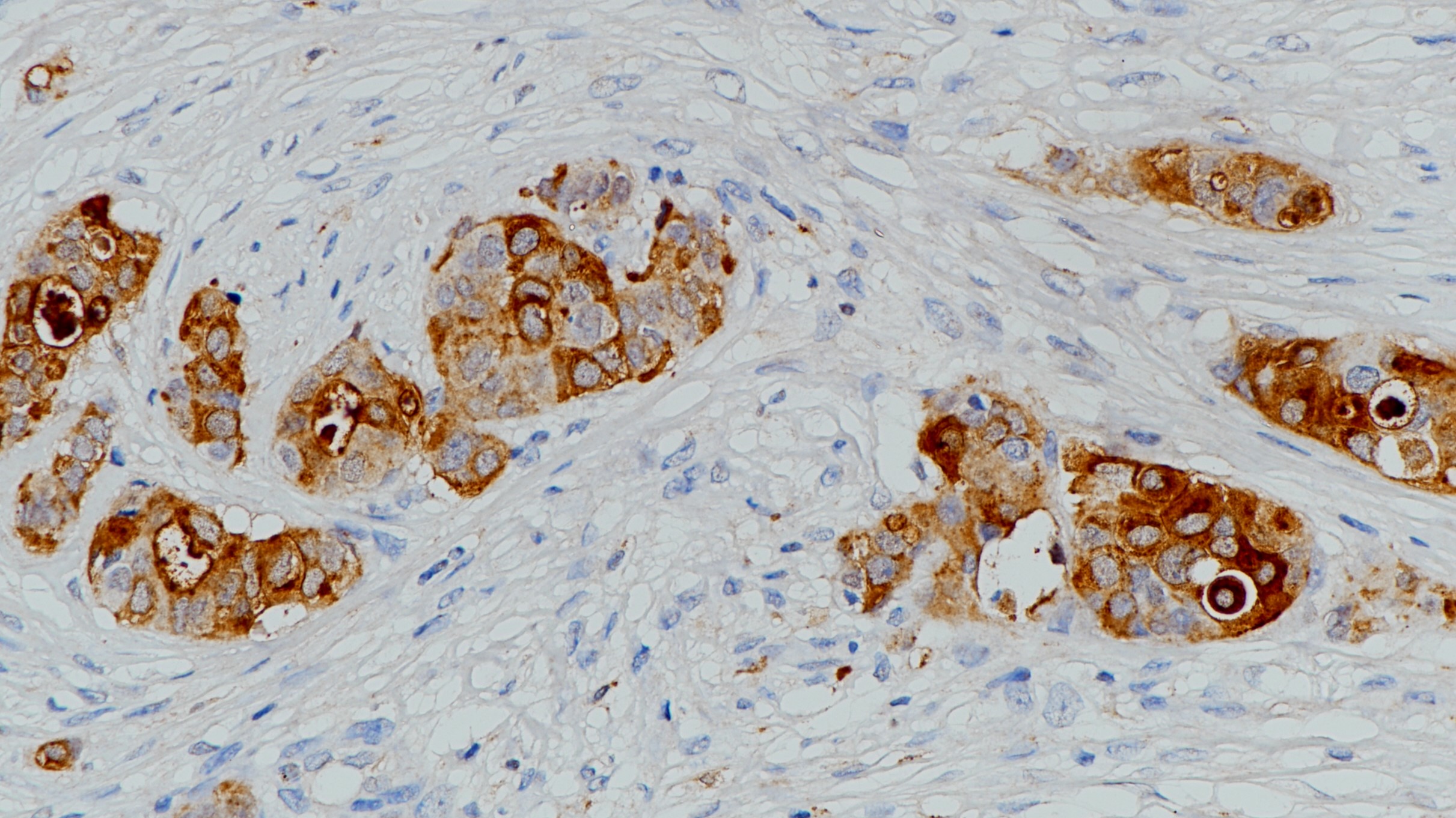 乳腺癌GCDFP-15(BP6118)染色