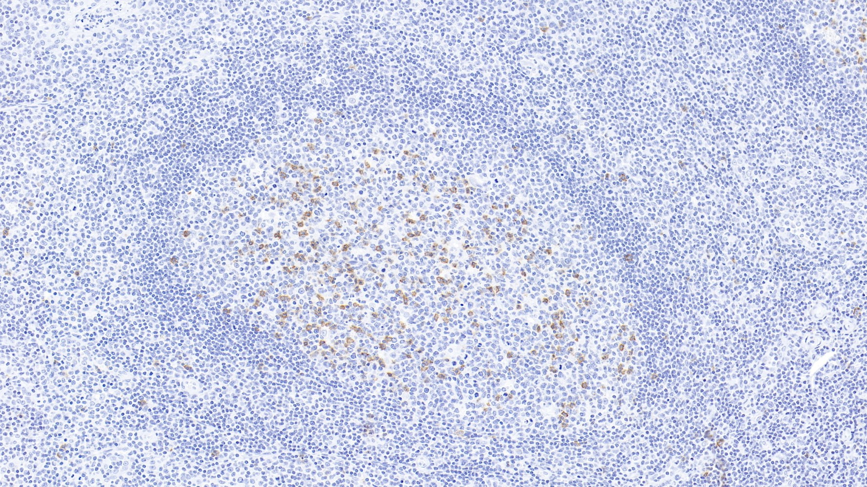 扁桃体CD57(MyM1-CD57)染色