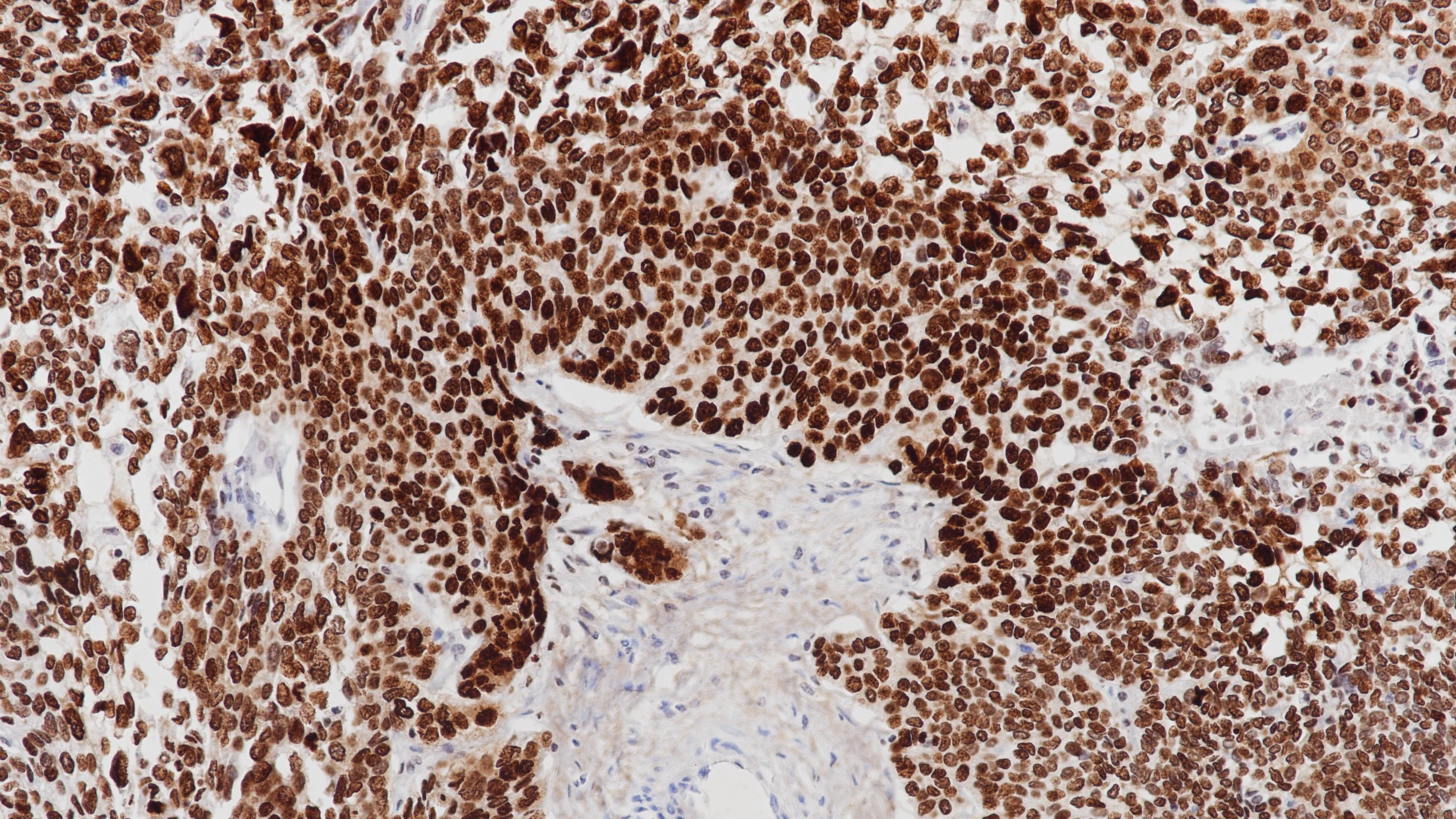 肺鳞癌SOX-2(BP6123)染色