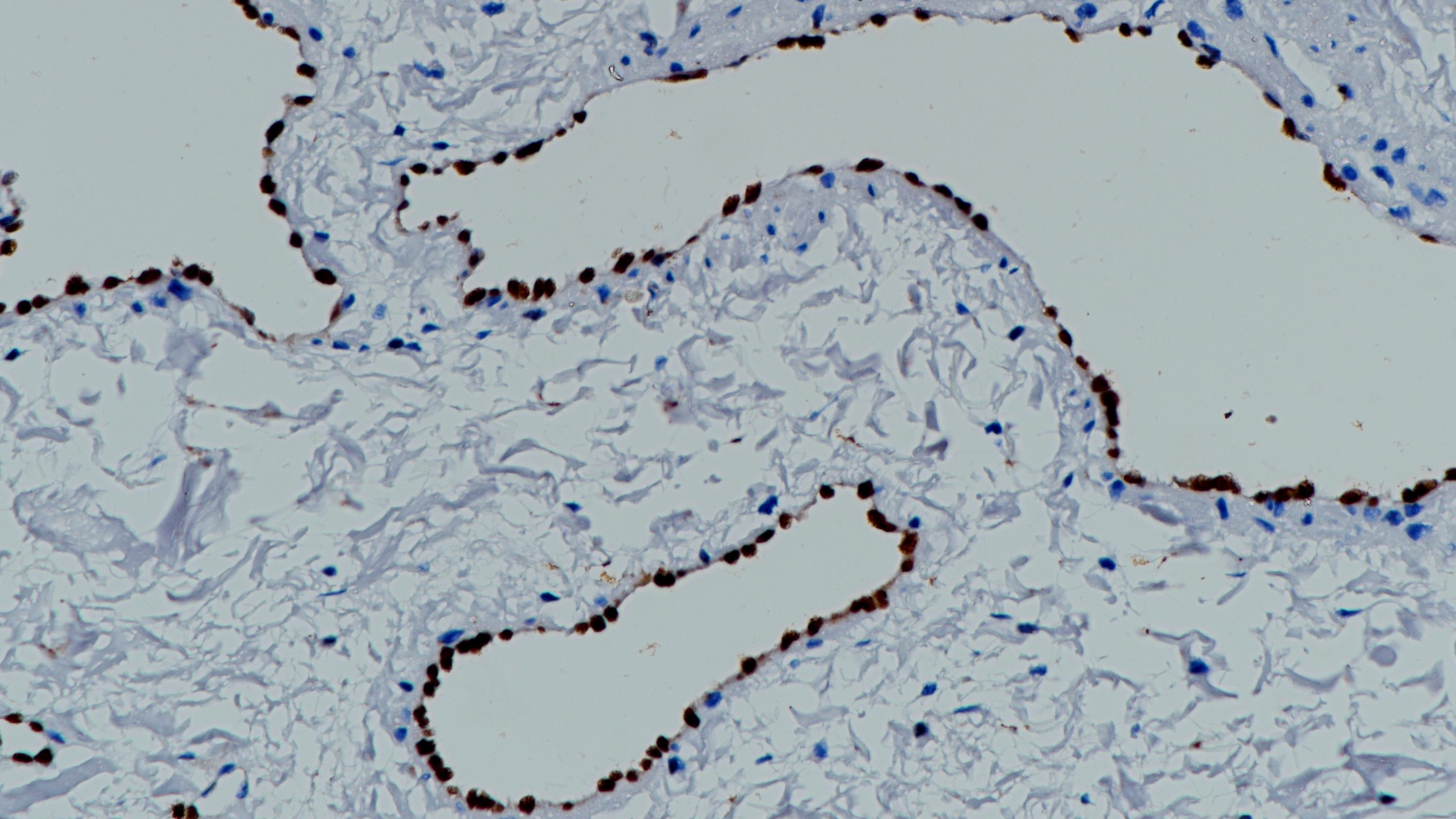 血管瘤ERG(BP6127)染色