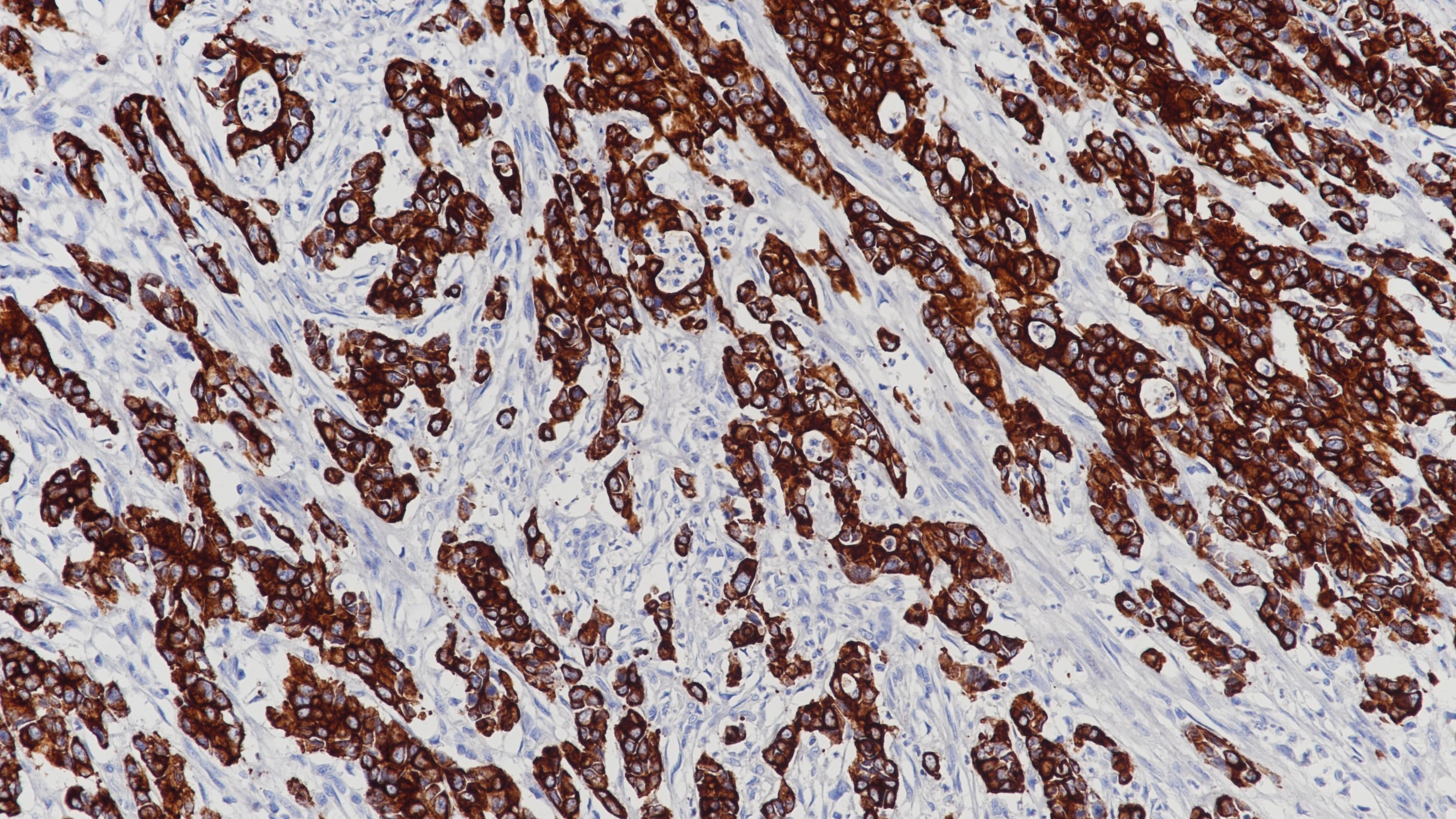 胃腺癌CK Pan (BP6051&6058)染色