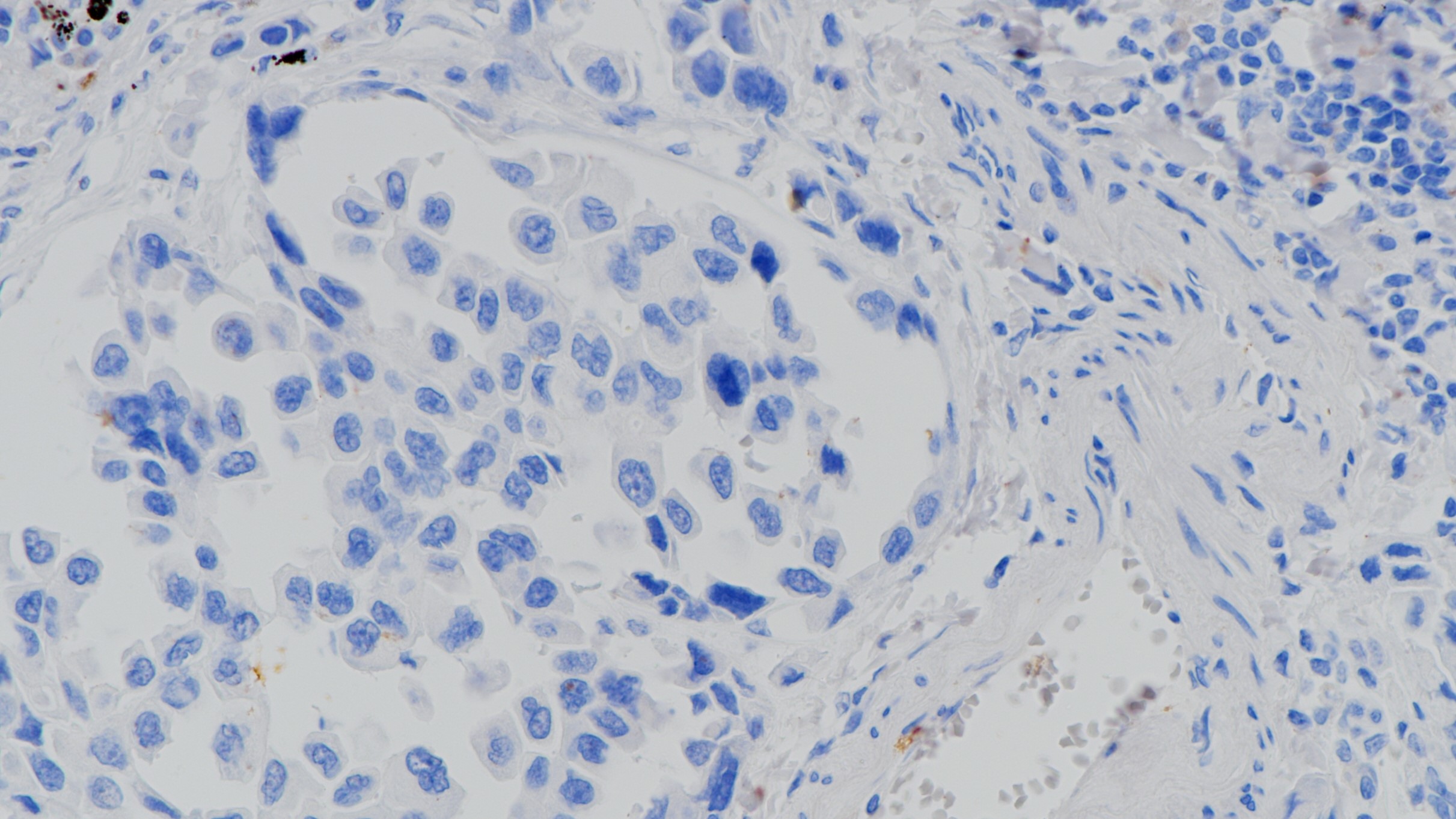 EGFR野生型肺腺癌(BP6098)染色