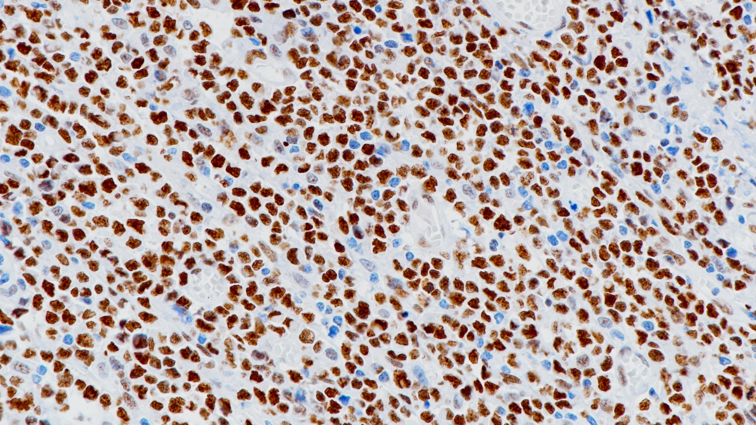 弥漫大B淋巴瘤FOXP1(BP6112)染色