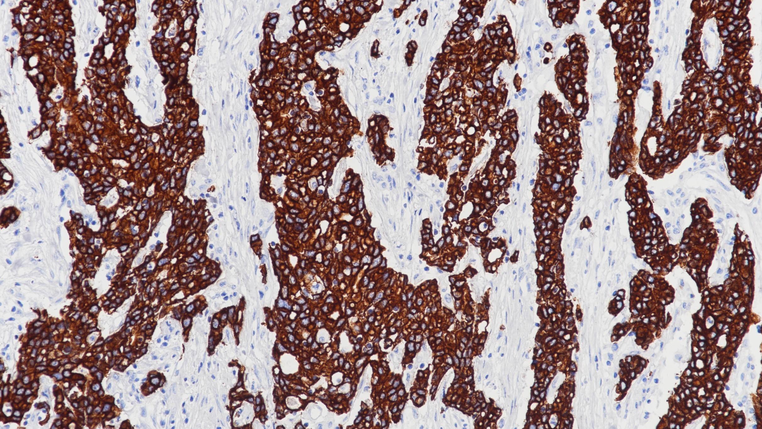 胃腺癌CK8&18(BP6054&BP6005)染色