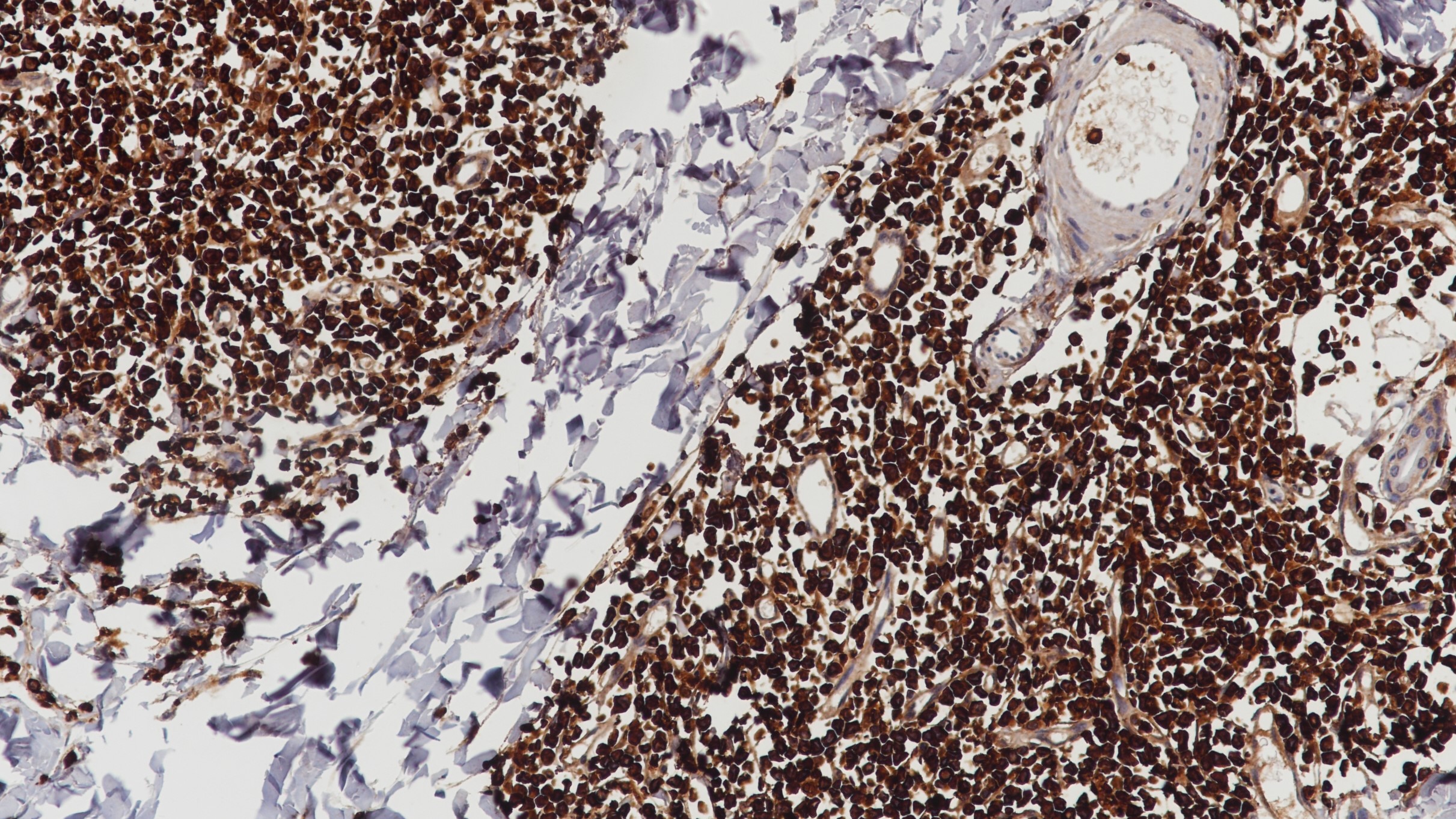 粒细胞肉瘤MPO(BP6104)染色
