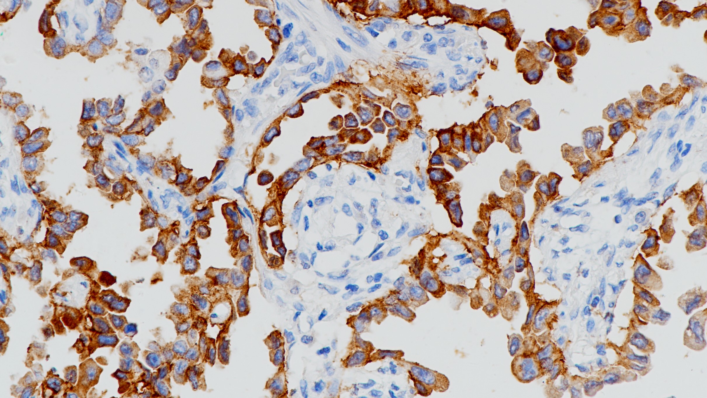 EGFR(L858R)突变肺腺癌(BP6098)染色