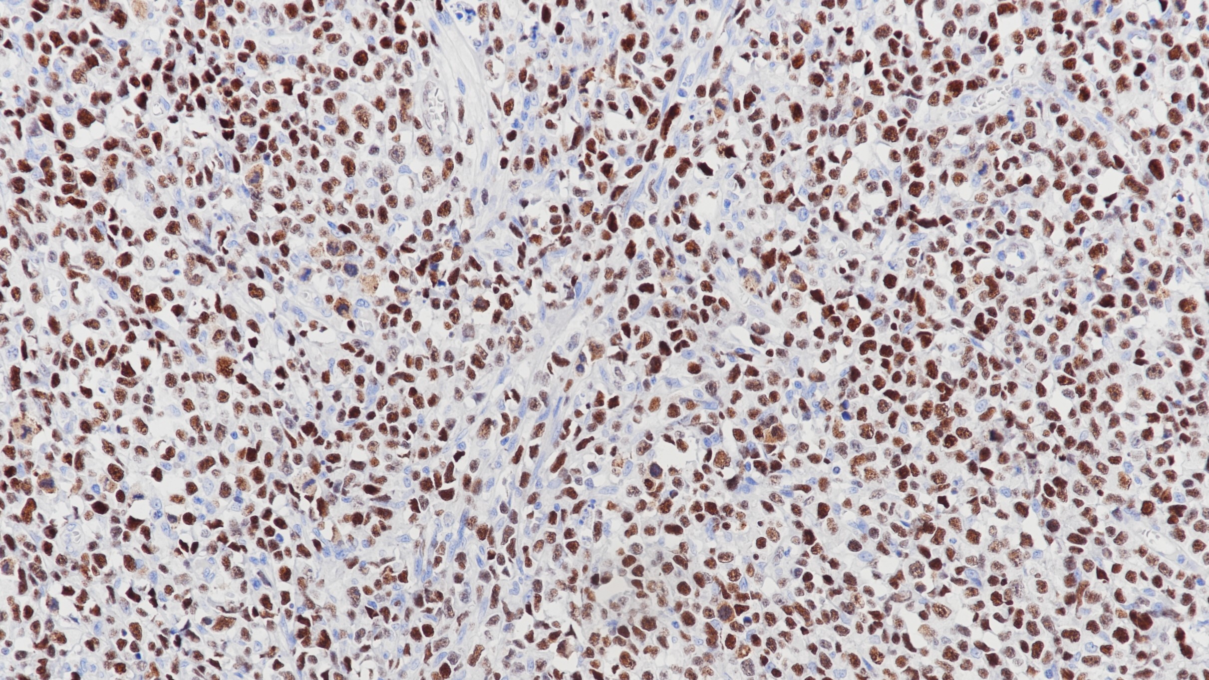 细胞淋巴瘤LEF-1(BP6113)染色