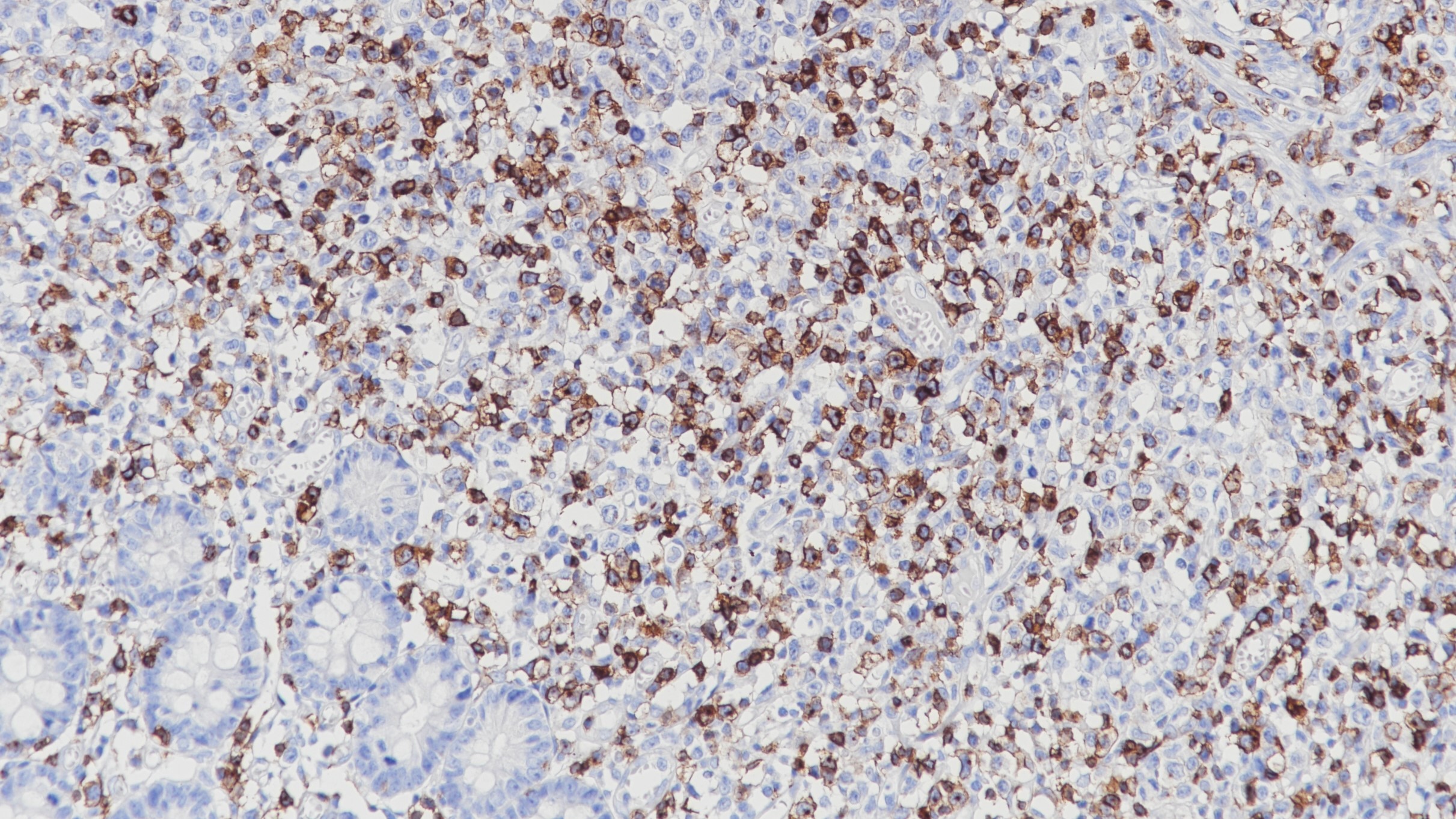 细胞淋巴瘤CD7(BP6105)染色