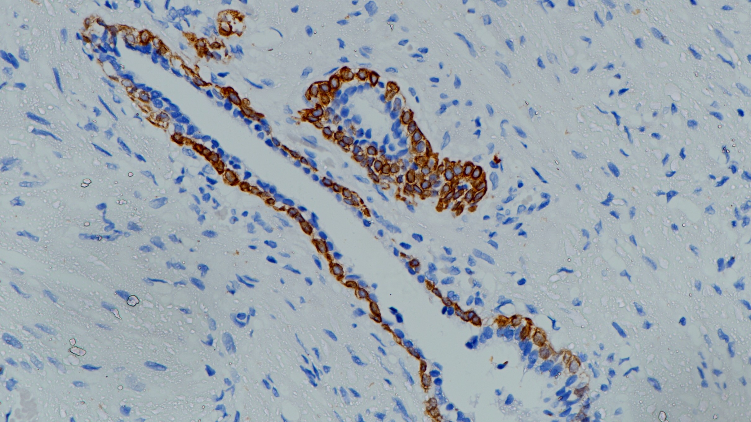 前列腺CK5&6(BP6021&BP6065)染色