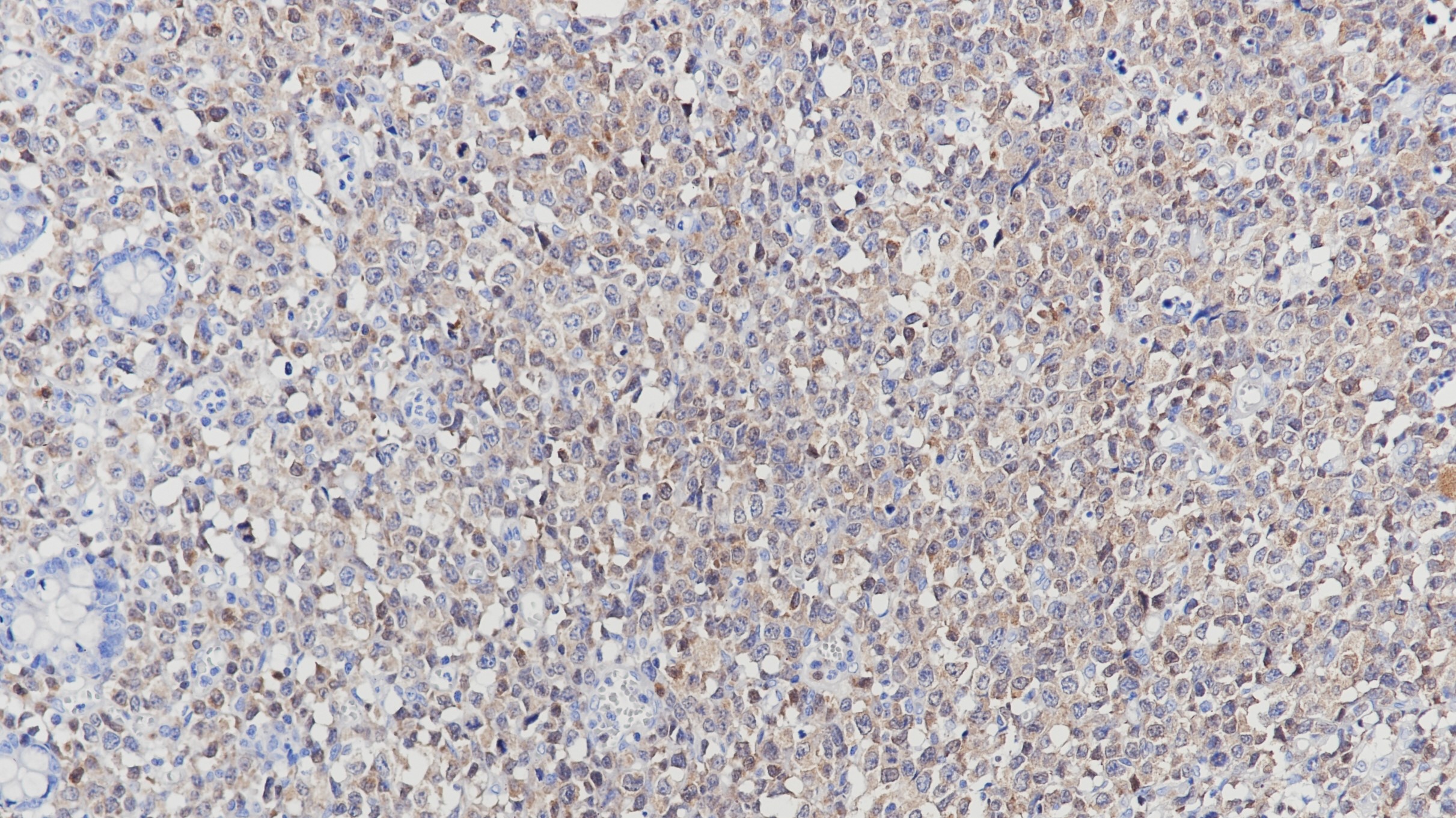 T细胞淋巴瘤ZAP-70(BP6106)染色