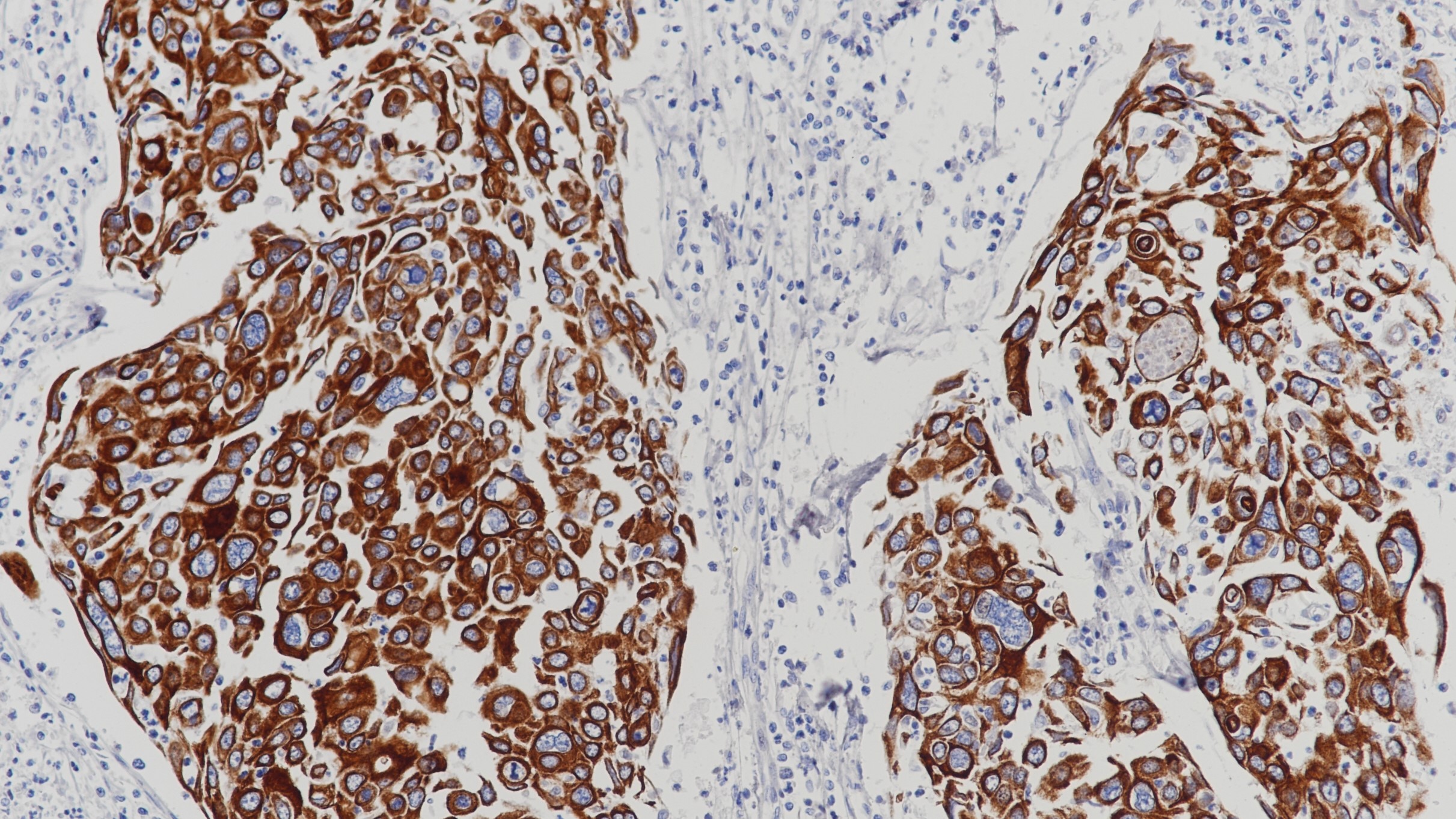 宫颈鳞癌CK(HMW)(BP6021&BP6077)染色