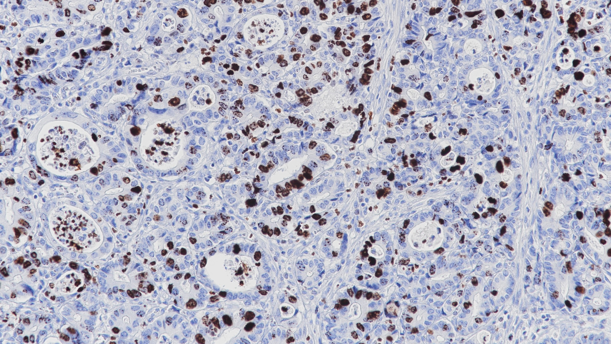 胃癌PHH3(BP6092)染色