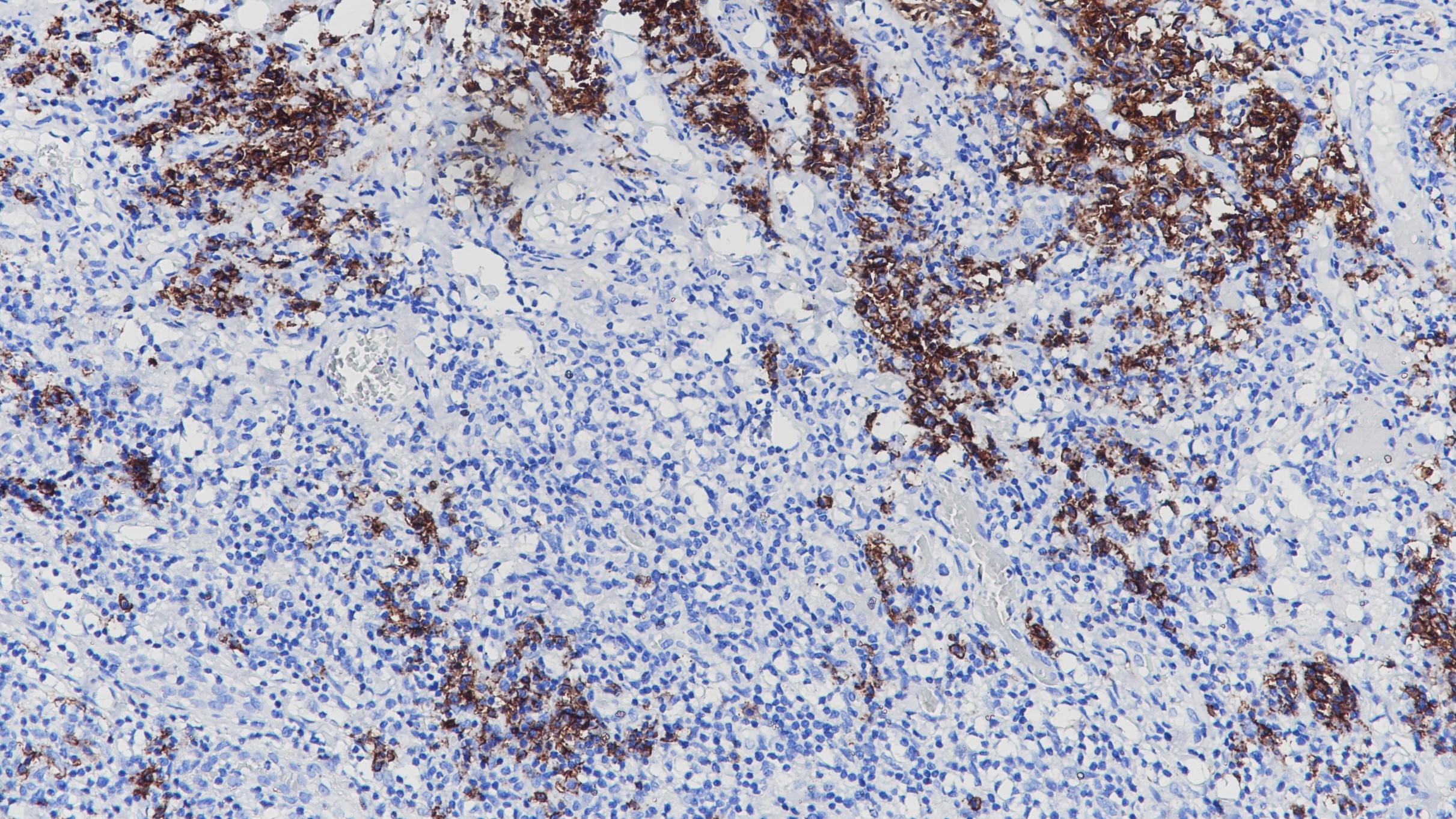 细胞淋巴瘤CD38(BP6082)染色