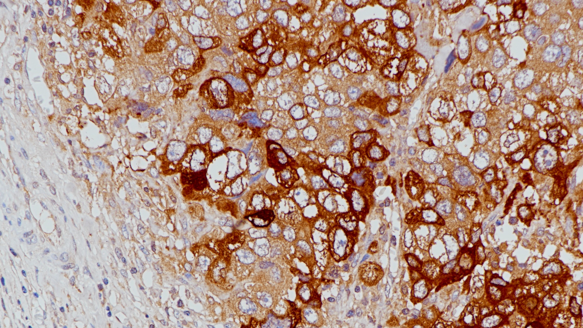 葡萄胎HCG(BP6080)染色