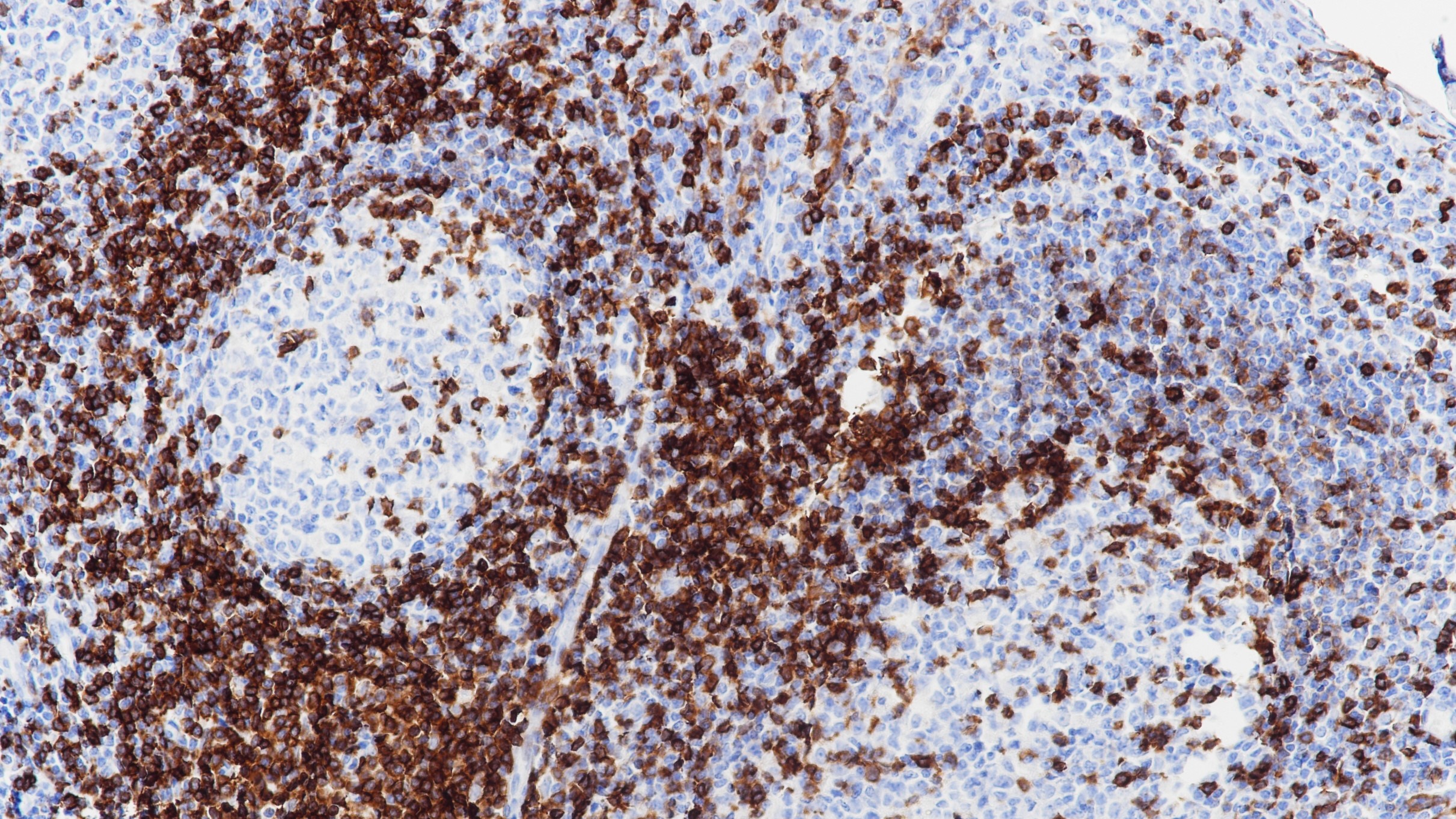 扁桃体CD5(BP6090)染色