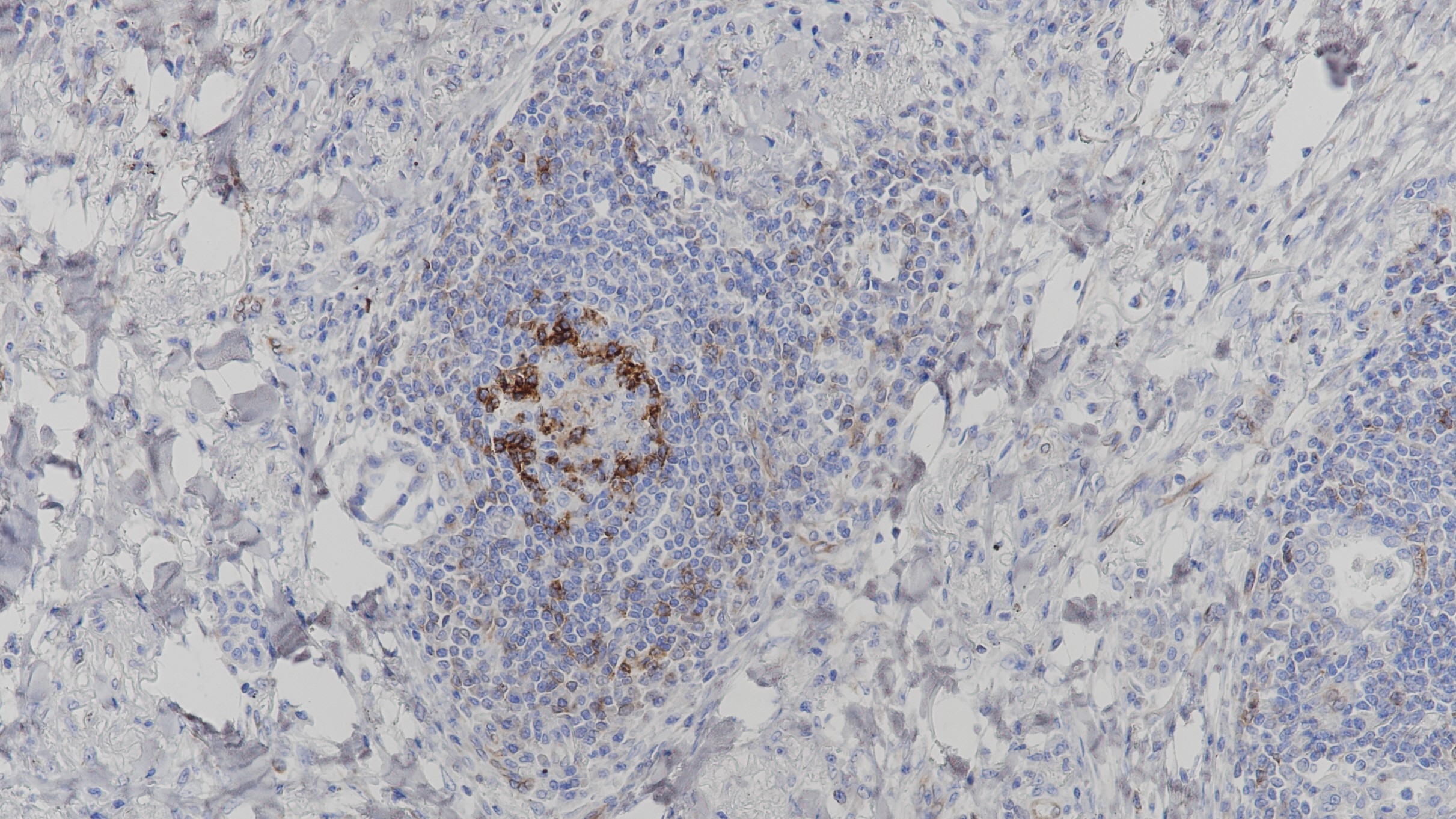 肺腺癌PD-1(BP6003) 染色