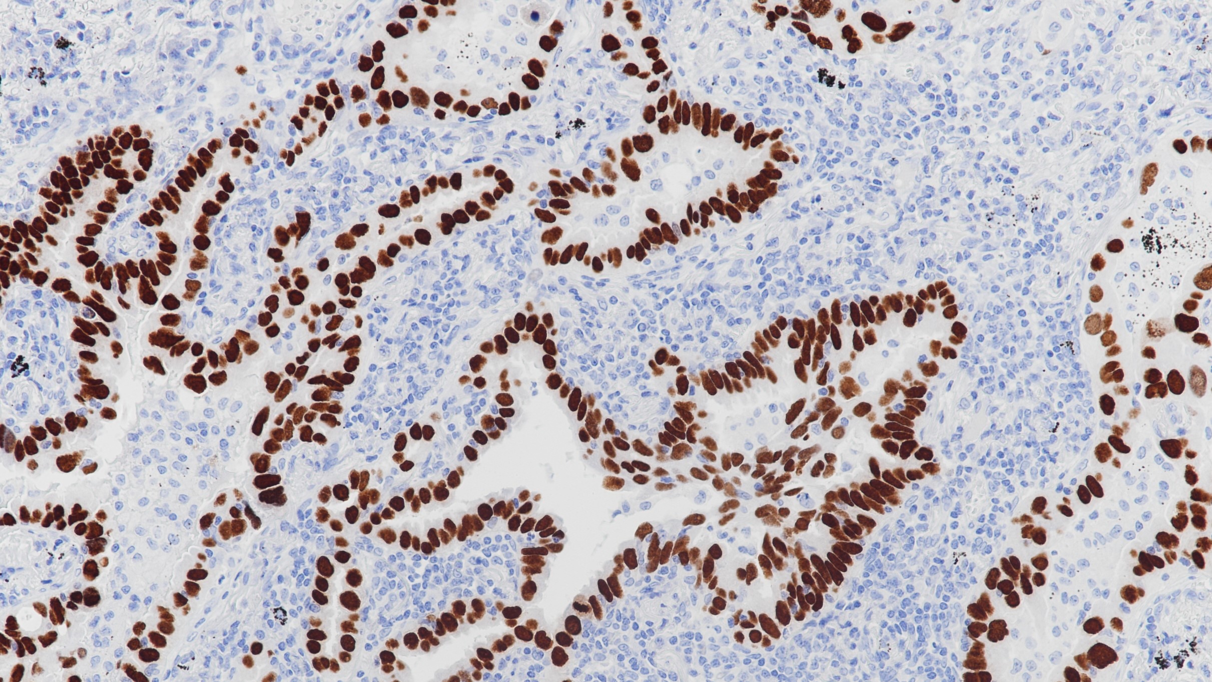 腺癌TTF-1(BP6079)染色
