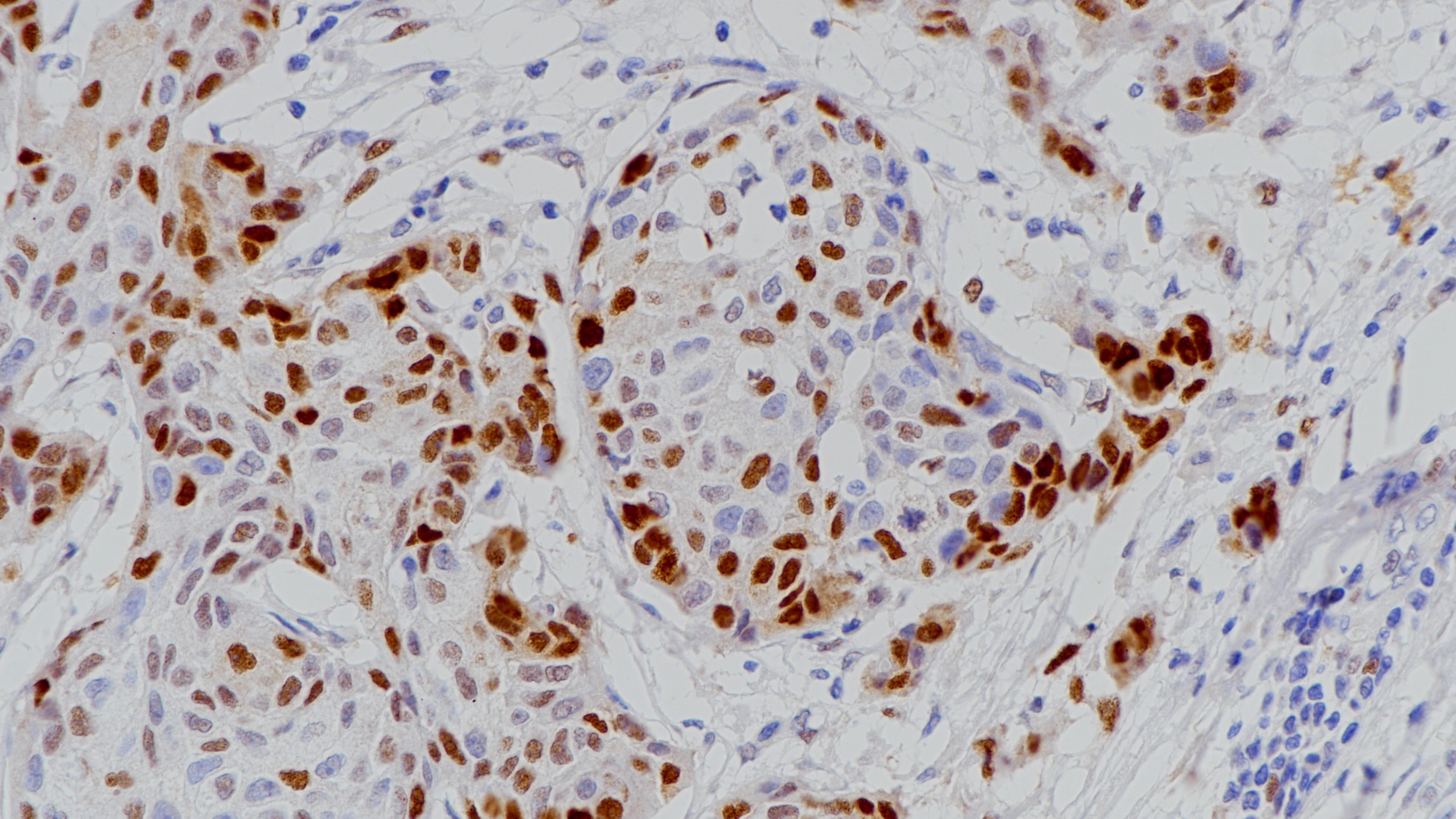 食管鳞癌p21(BP6068)染色