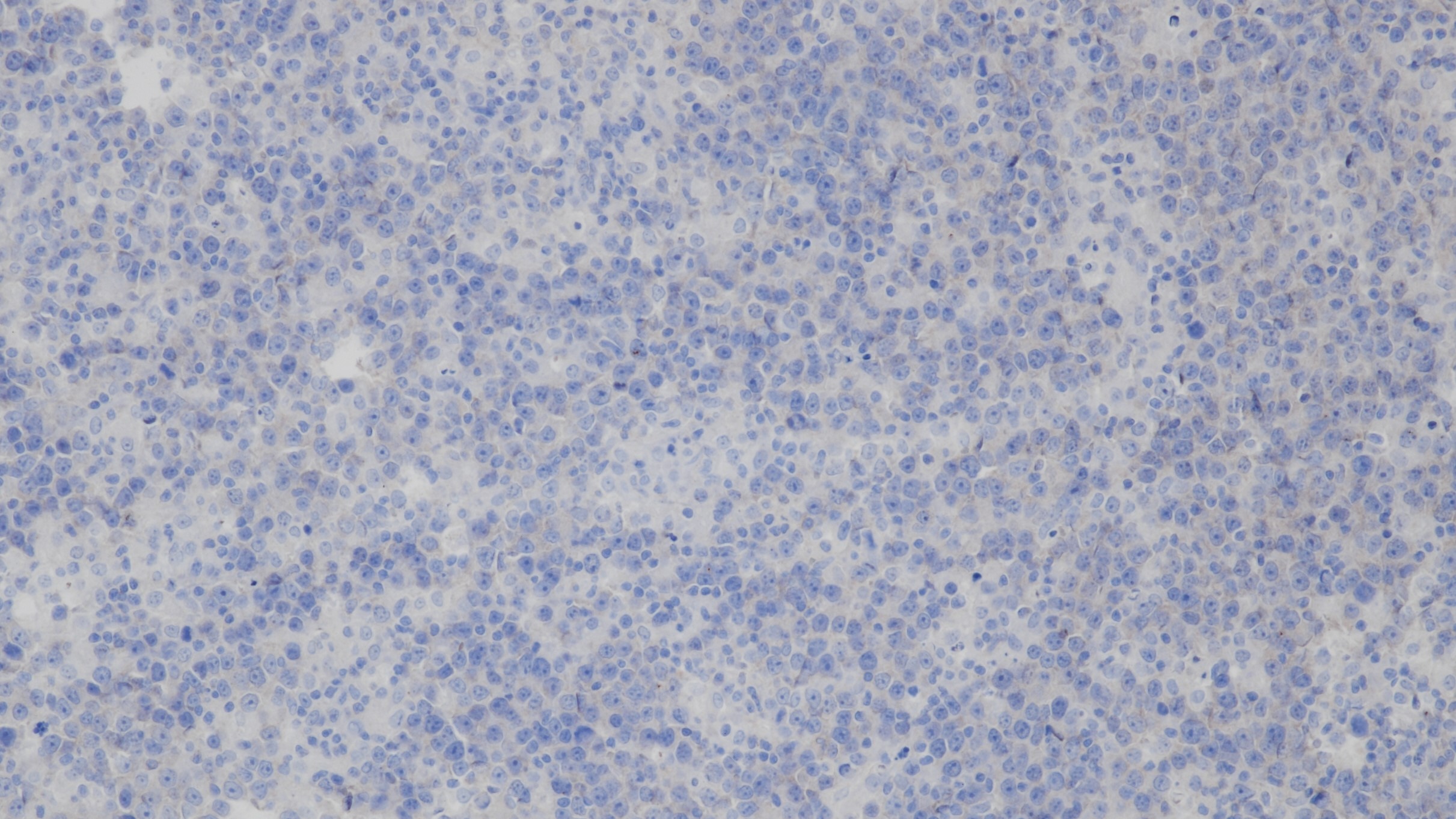 SOX-11(BP6070)弥漫大B淋巴瘤 阴性组织染色