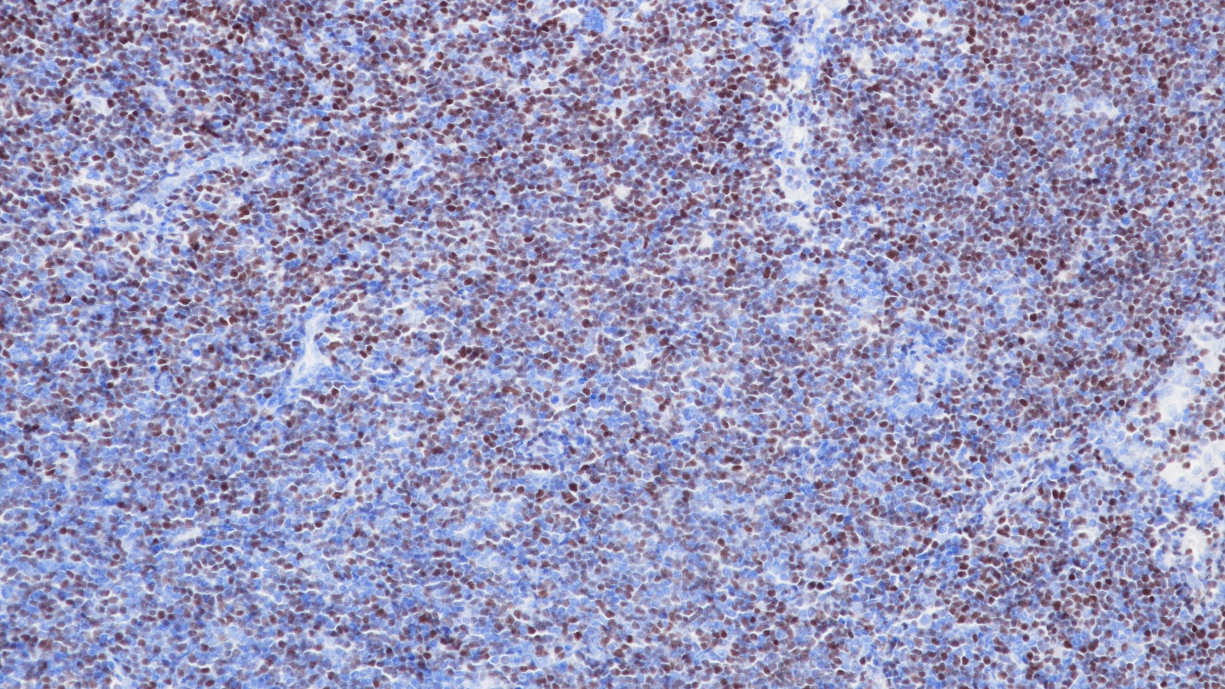 套细胞淋巴瘤SOX-11(BP6070)染色