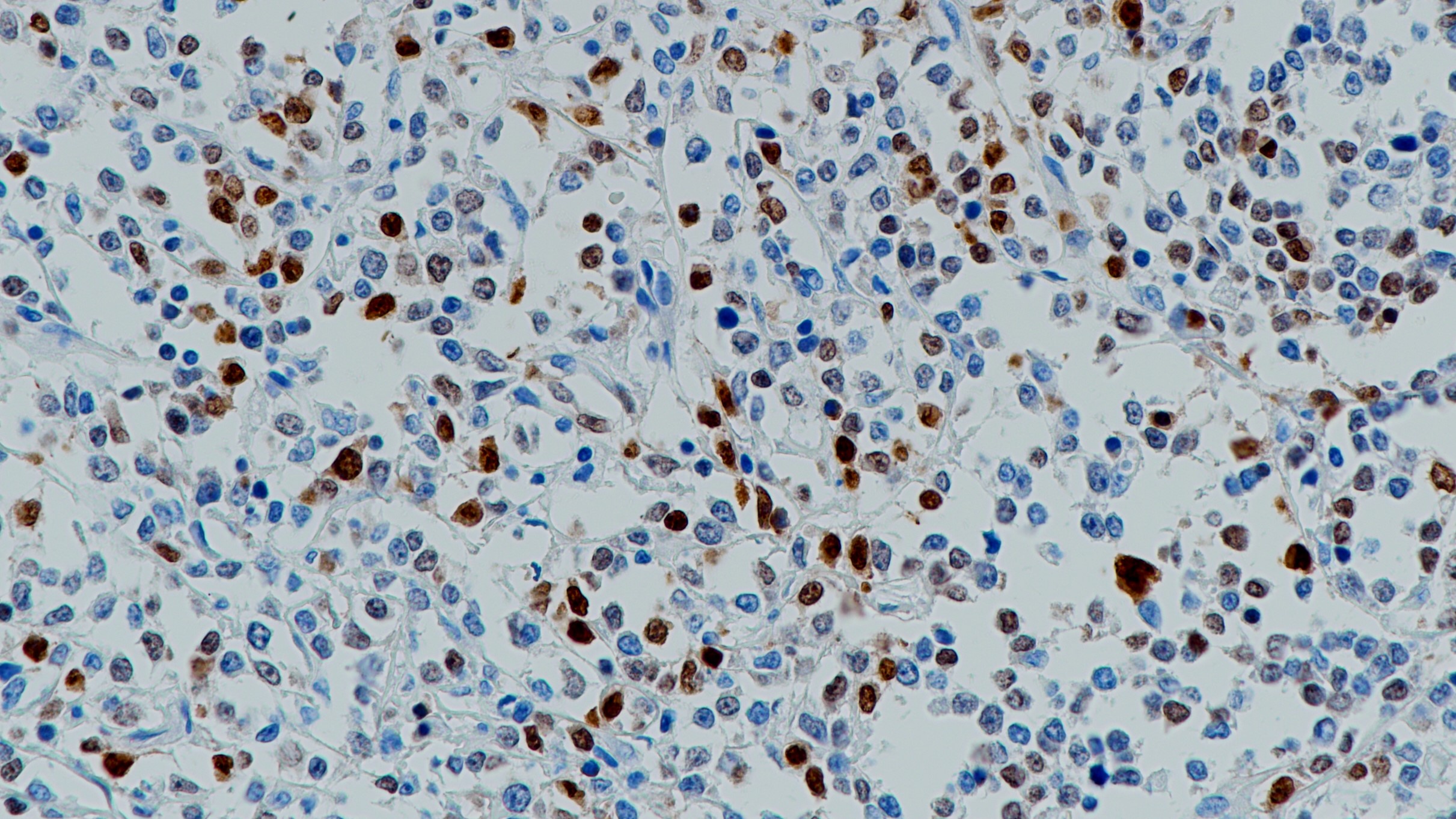 弥漫大B细胞淋巴瘤MUM1(BP6094)染色