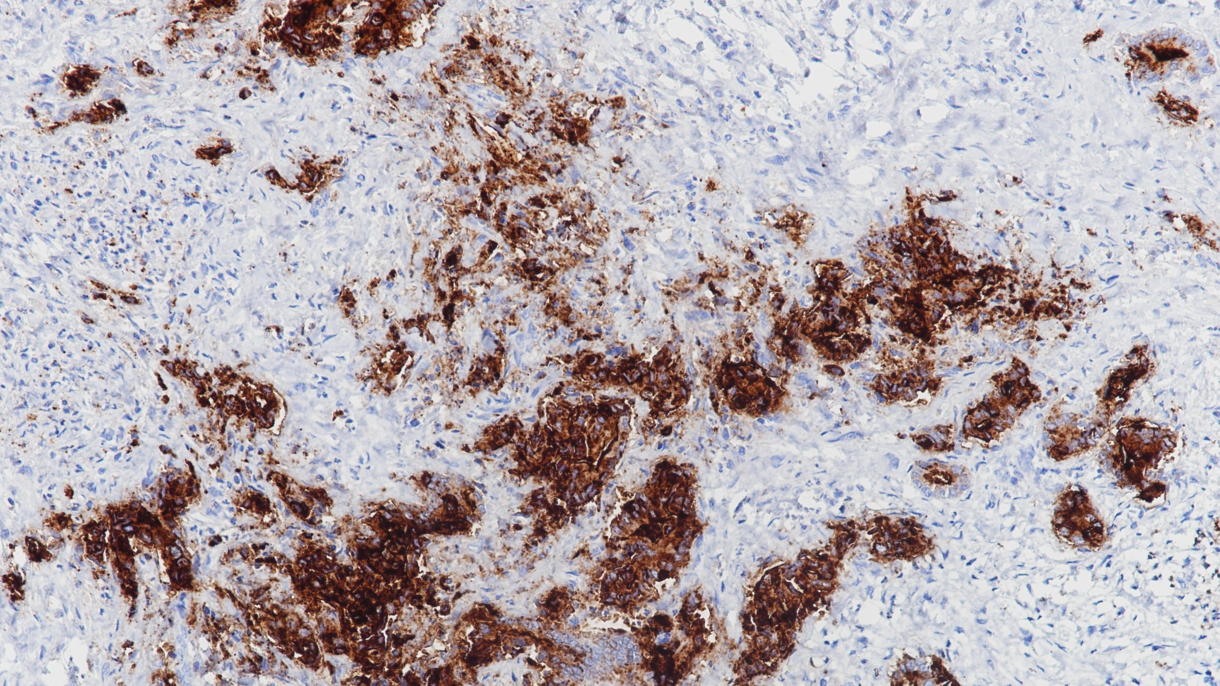 胆管细胞癌CEA(BP6085)染色