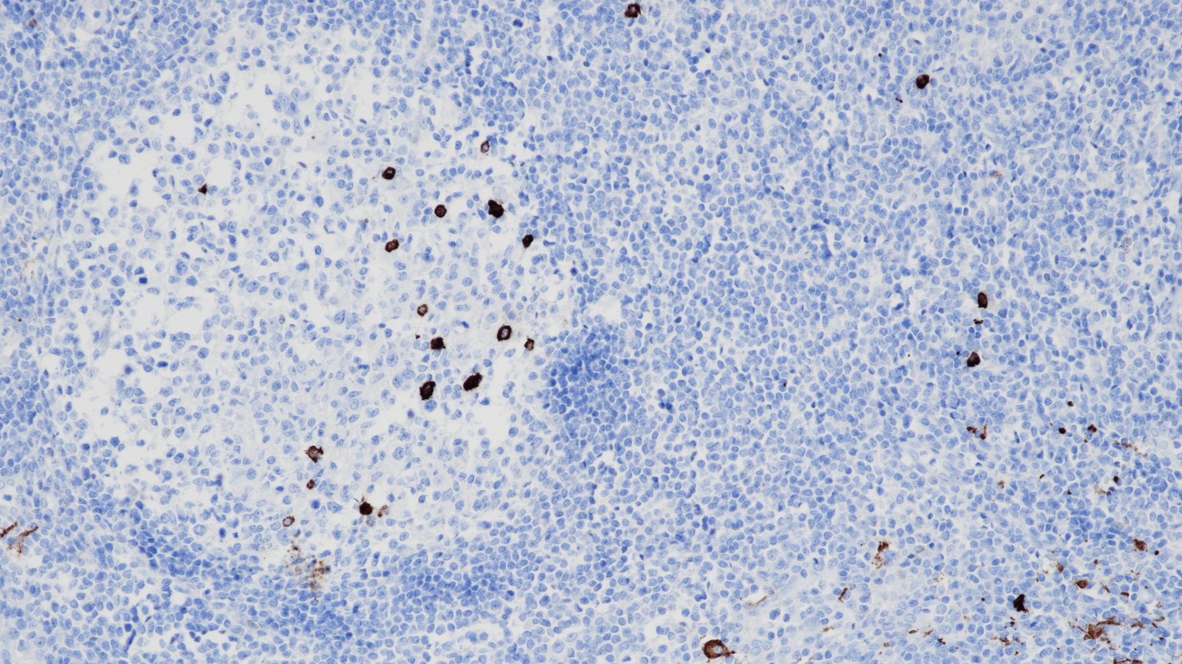 扁桃体CD163(BP6063)染色