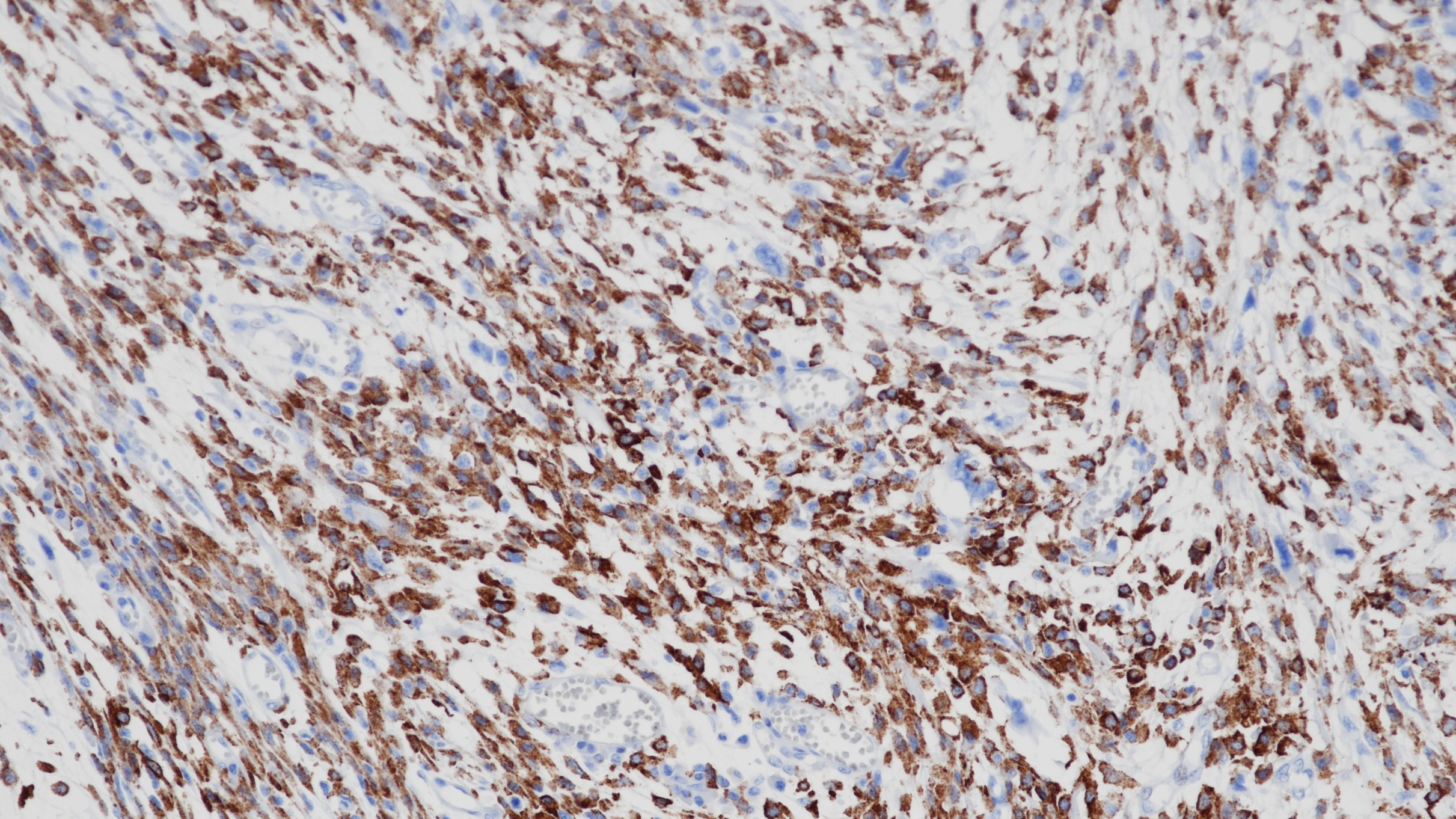 恶性纤维组织细胞瘤CD163(BP6063)染色