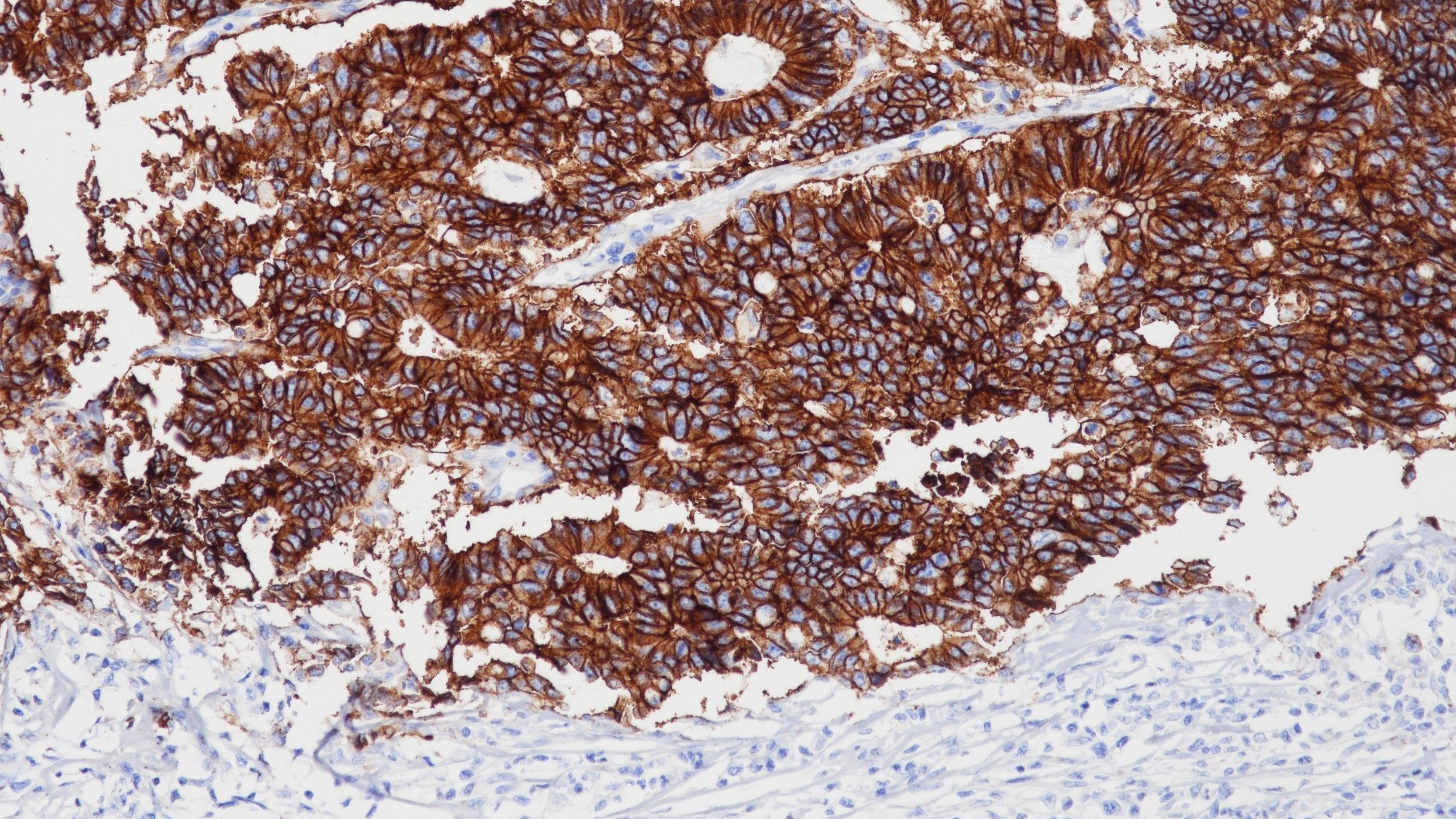 结肠癌Ep-CAM(BP6056)染色