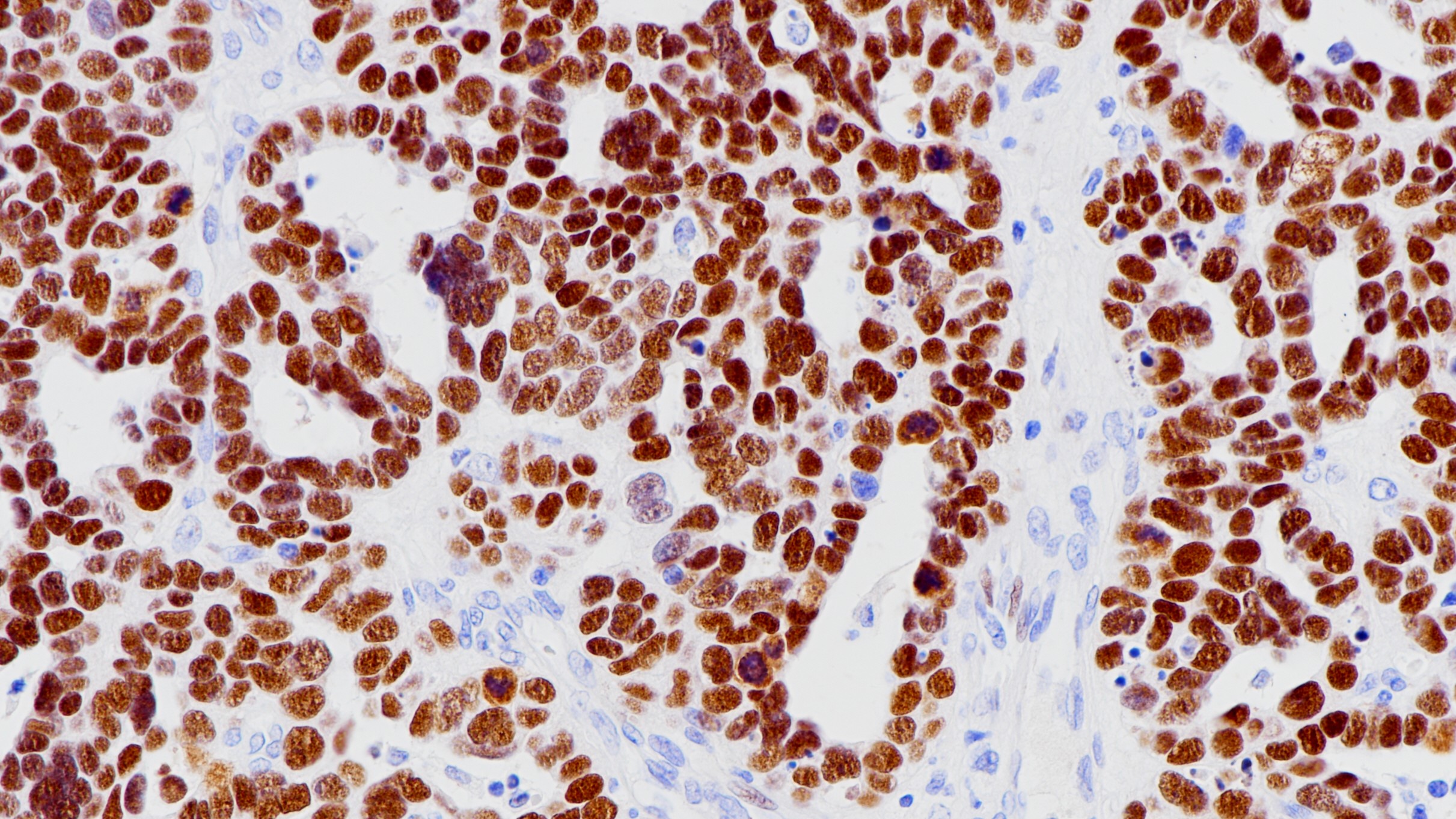 浆液性卵巢癌WT1(BP6062)染色