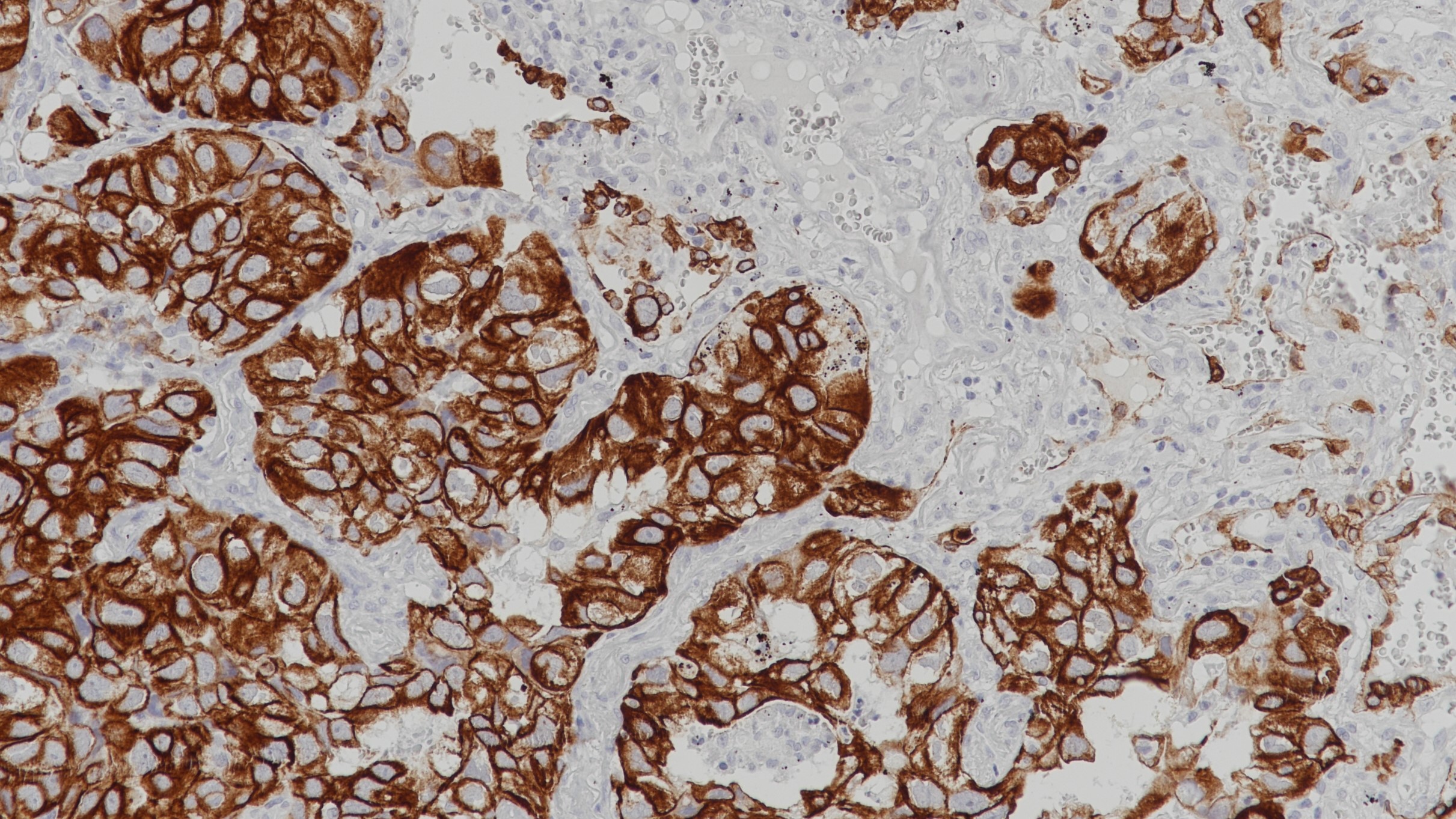 肺腺癌CK7(BP6060)染色