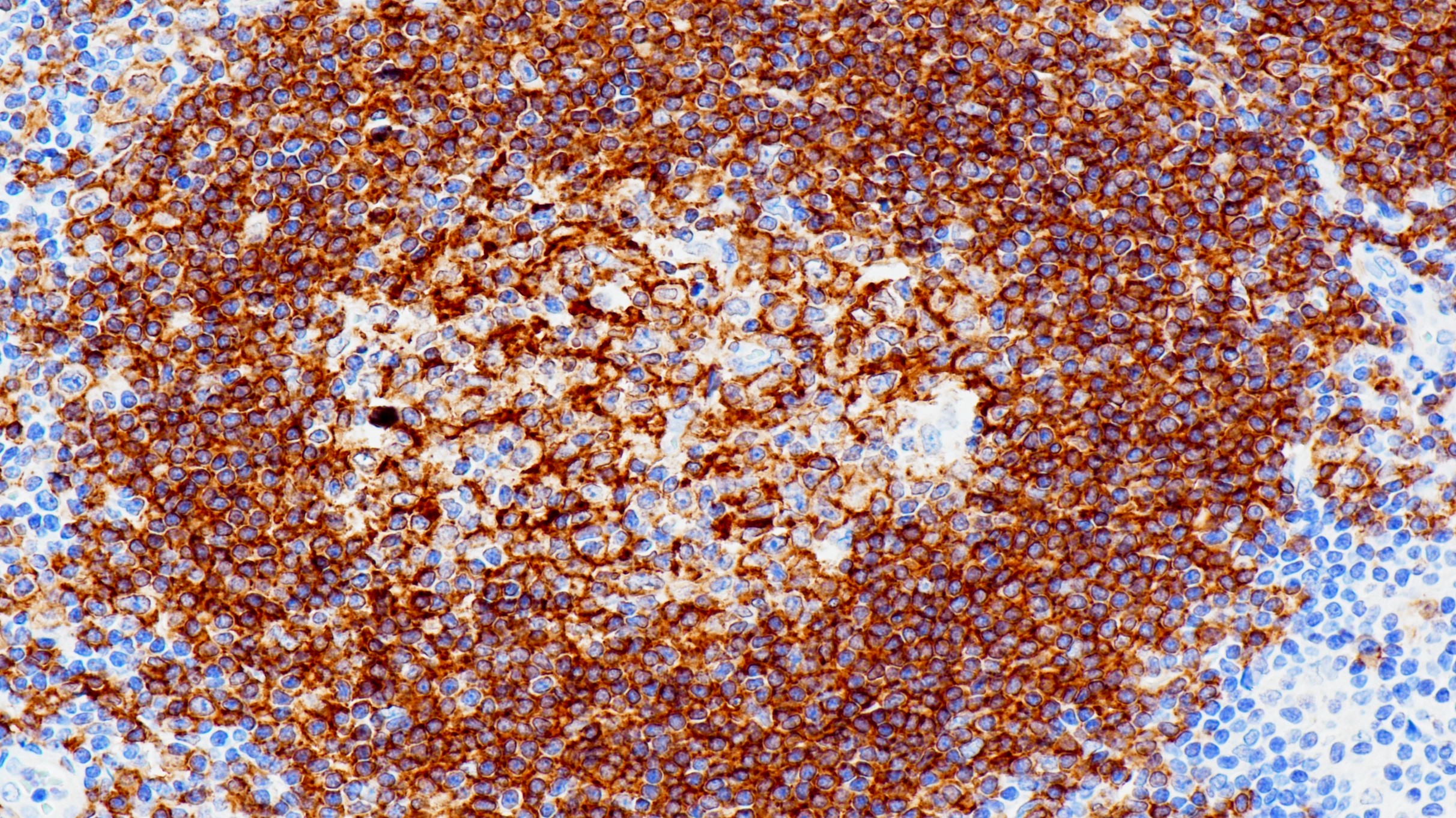 扁桃体CD19(BP6046)染色
