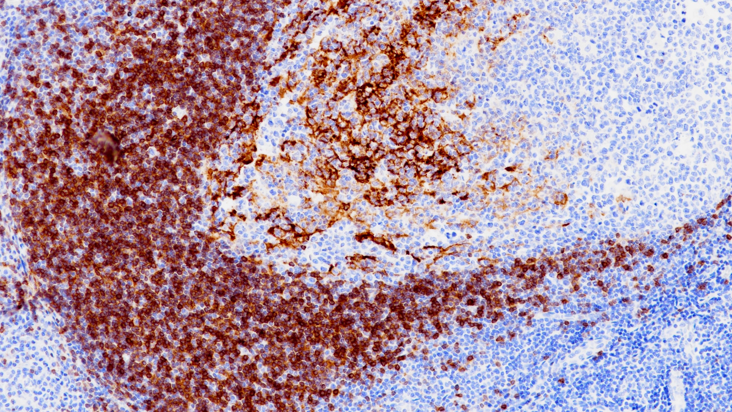 扁桃体 CD23(BP6049)染色