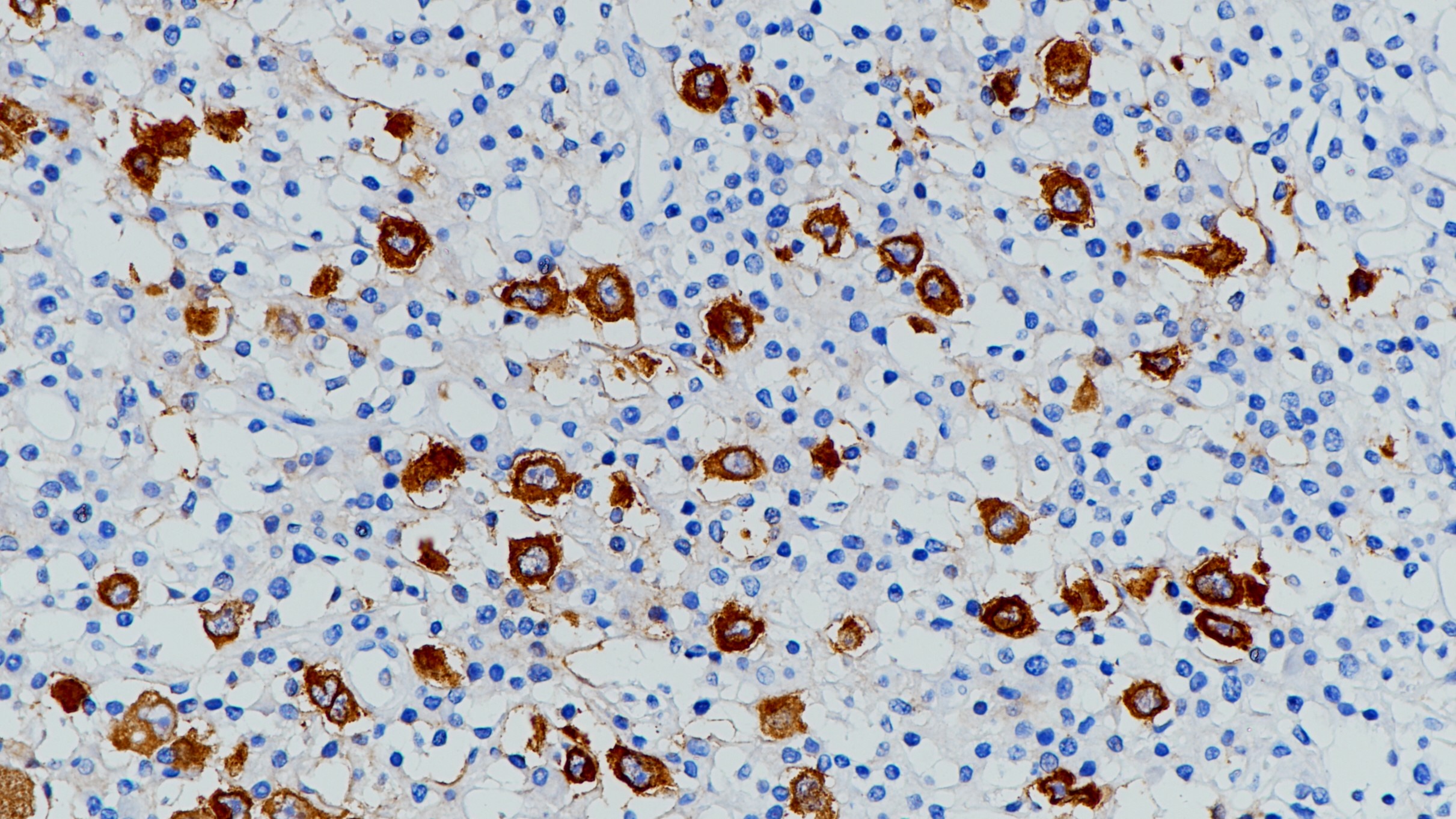 霍奇金淋巴瘤CD30(BP6012)染色