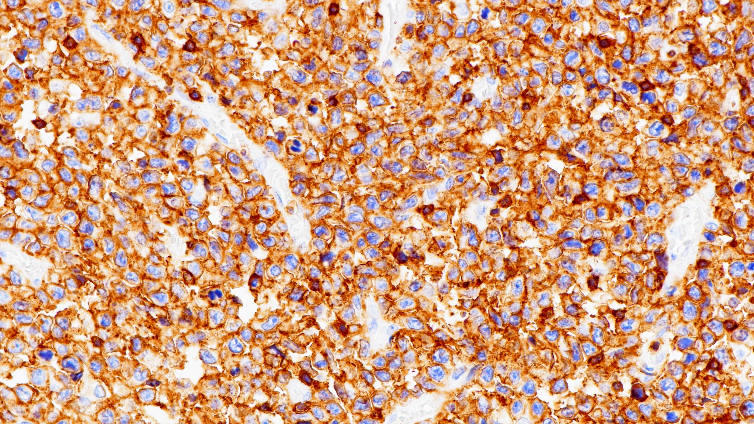 弥漫大B细胞淋巴瘤CD45(BP6073)染色