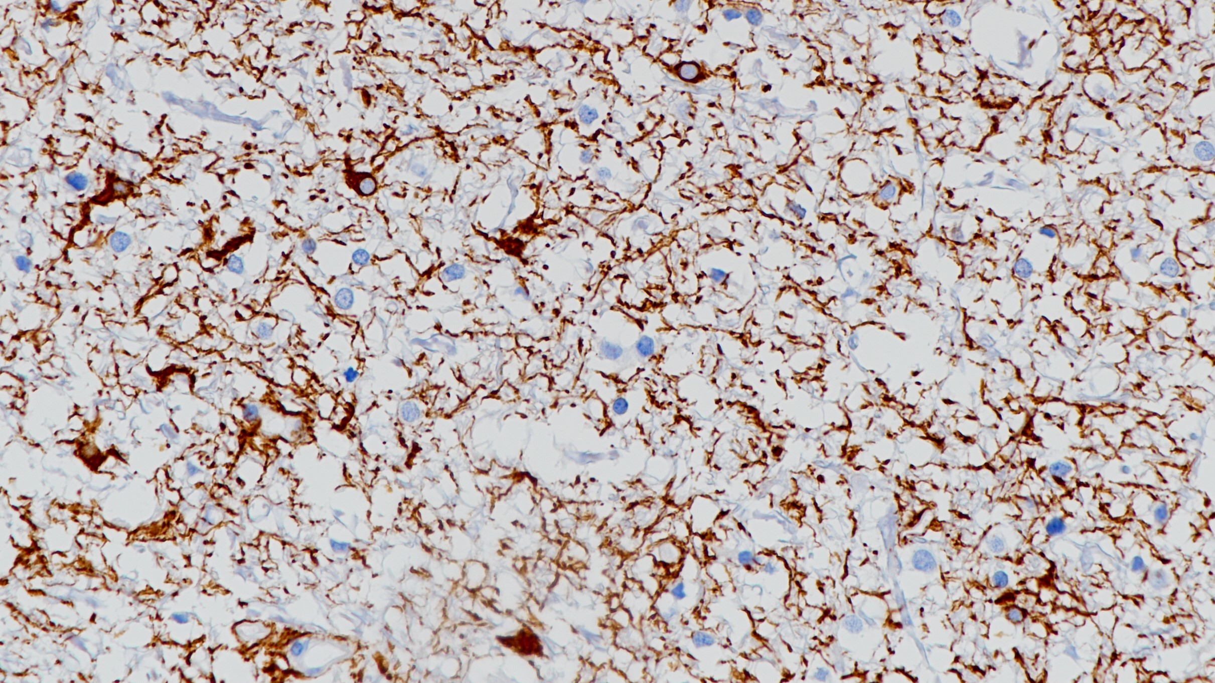 脑胶质瘤GFAP(BP6061)染色