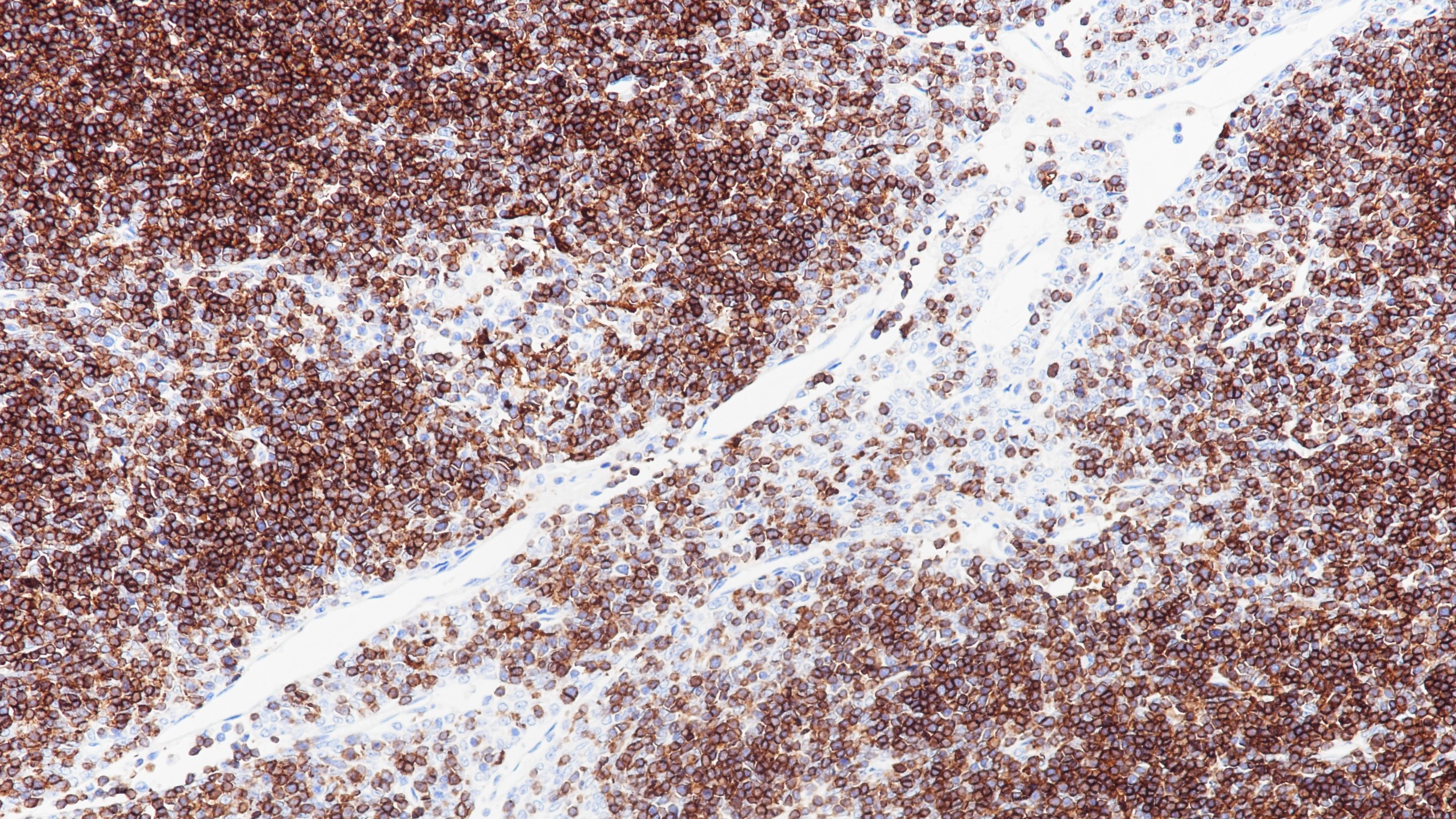 胸腺瘤CD1a(BP6055)染色