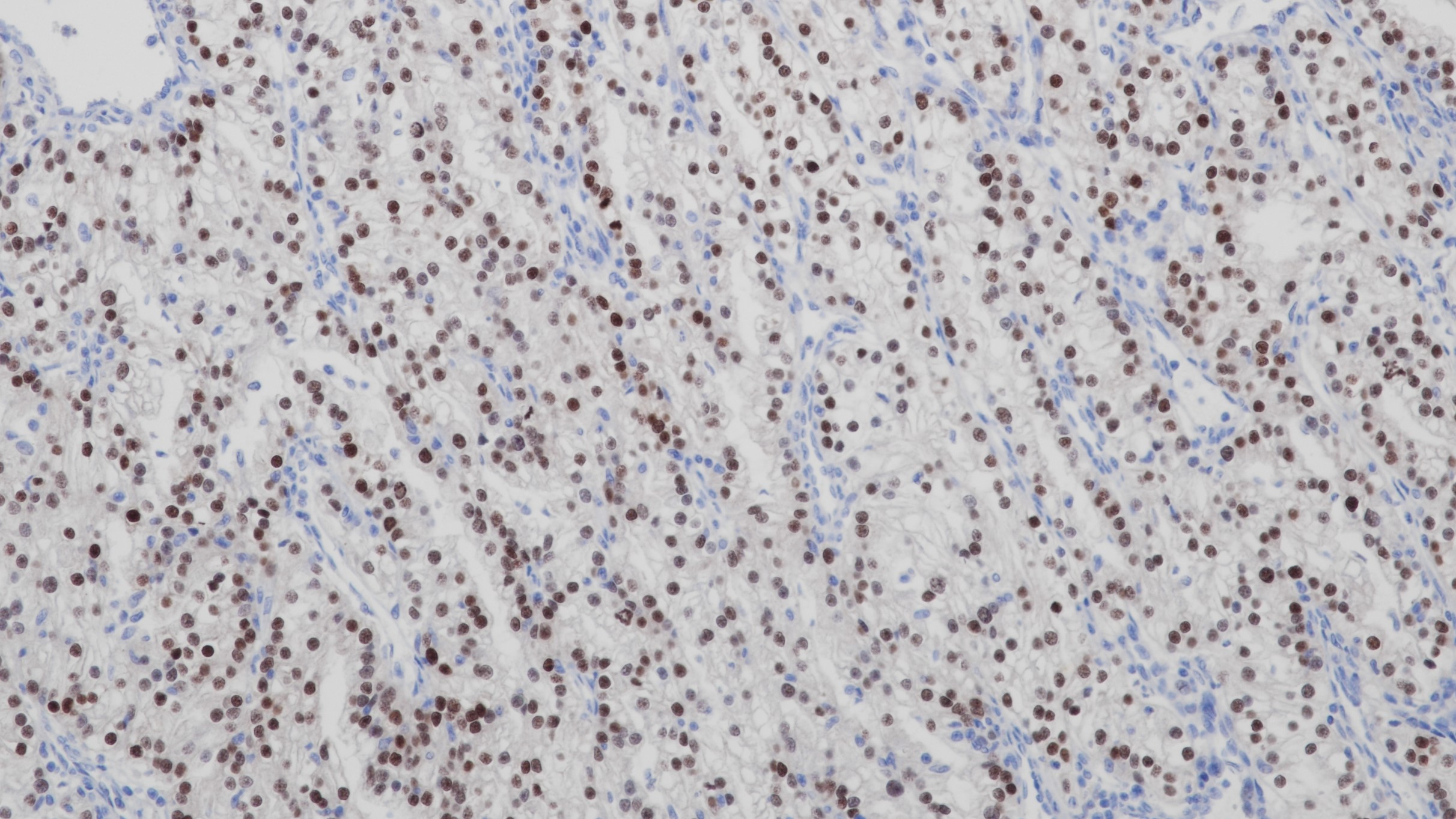肾透明细胞癌PAX-2(BP6044)染色