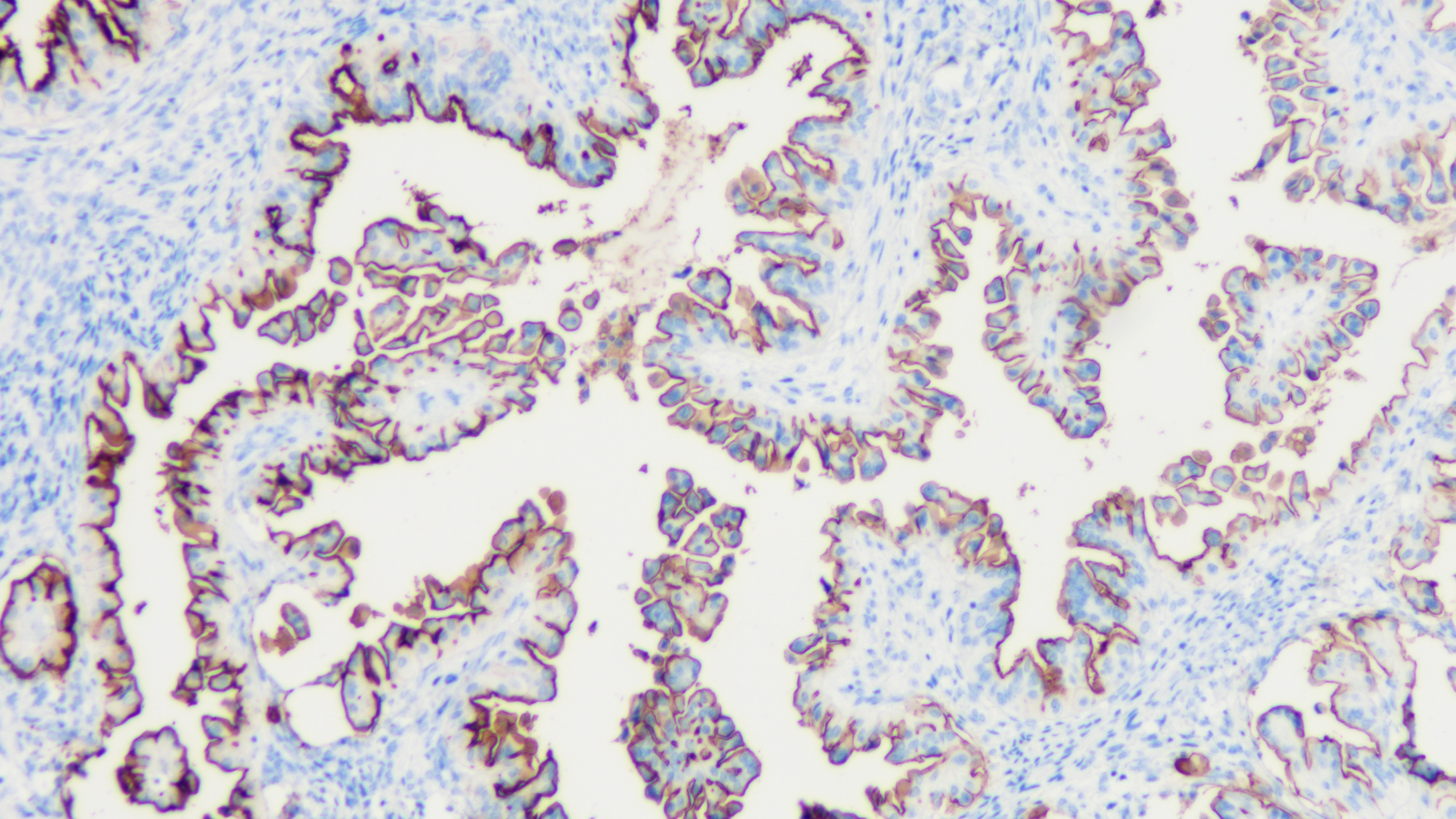 卵巢癌MUC1(BP6034)染色