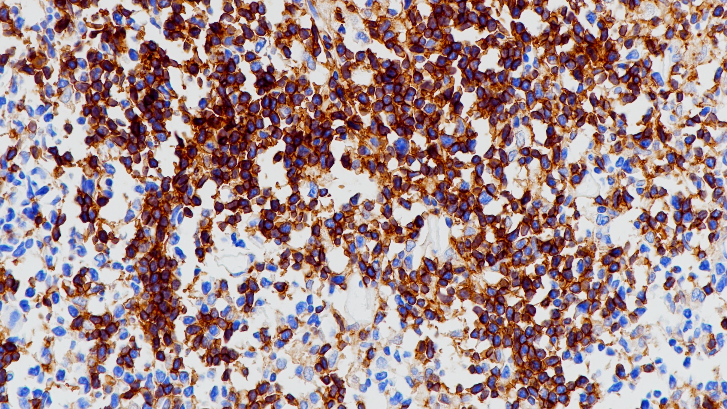 T细胞淋巴瘤CD4(BP6028)染色