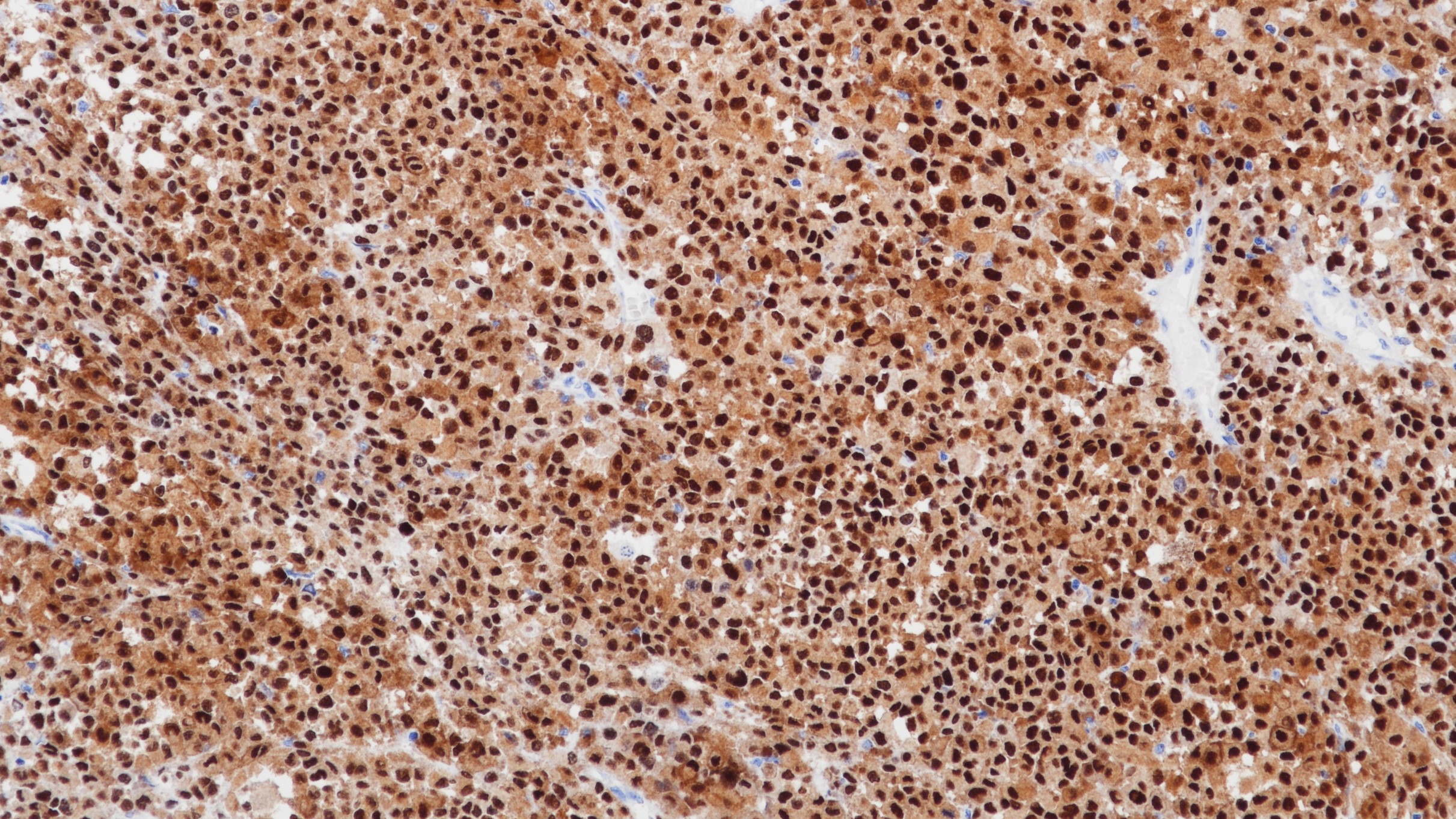 恶性黑色素瘤SOX-10(BP6024)染色