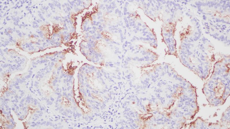 子宫内膜癌CA125(BP6014)染色