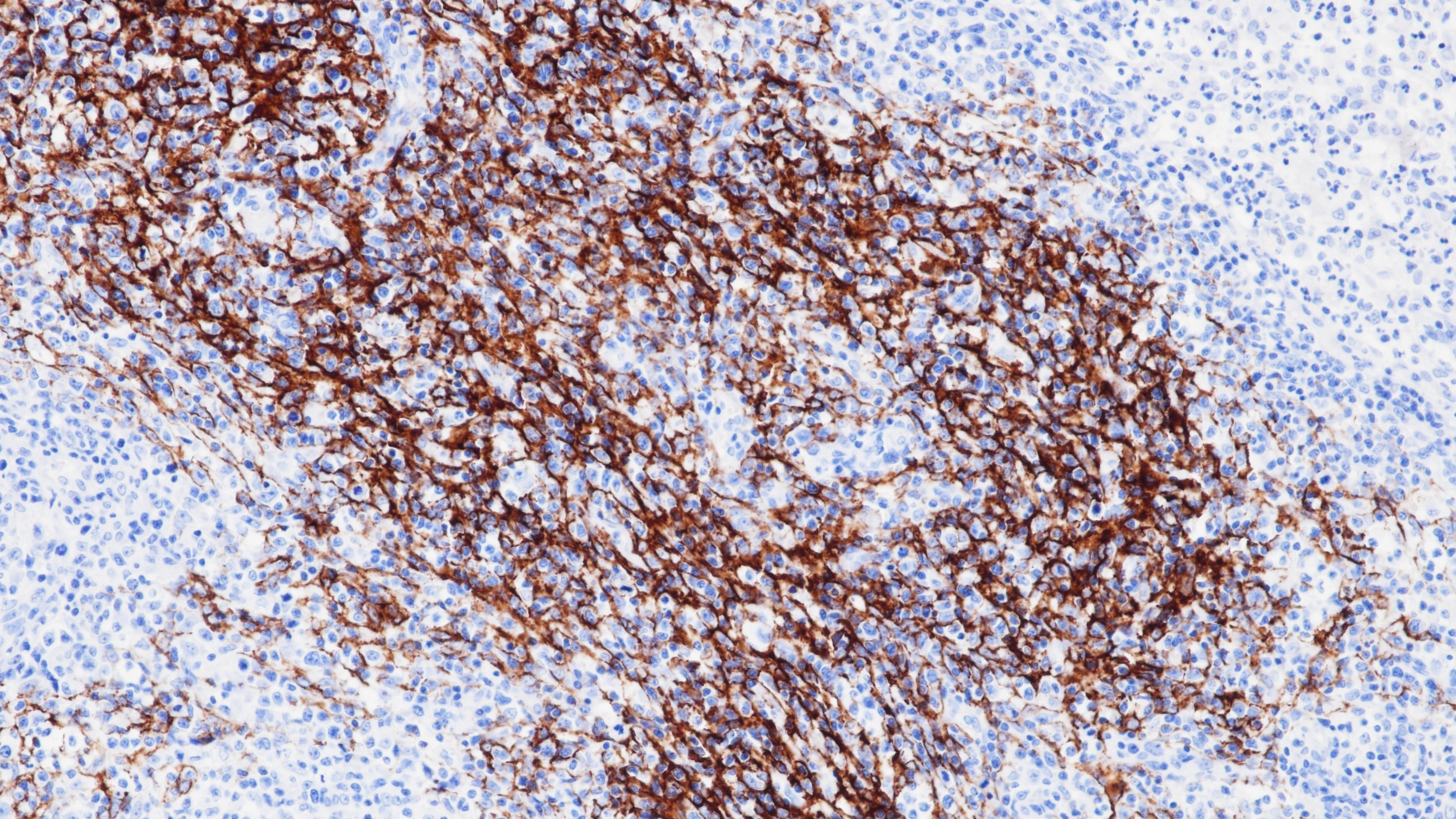 血管免疫母细胞性T细胞淋巴瘤CD21(BP6015)染色