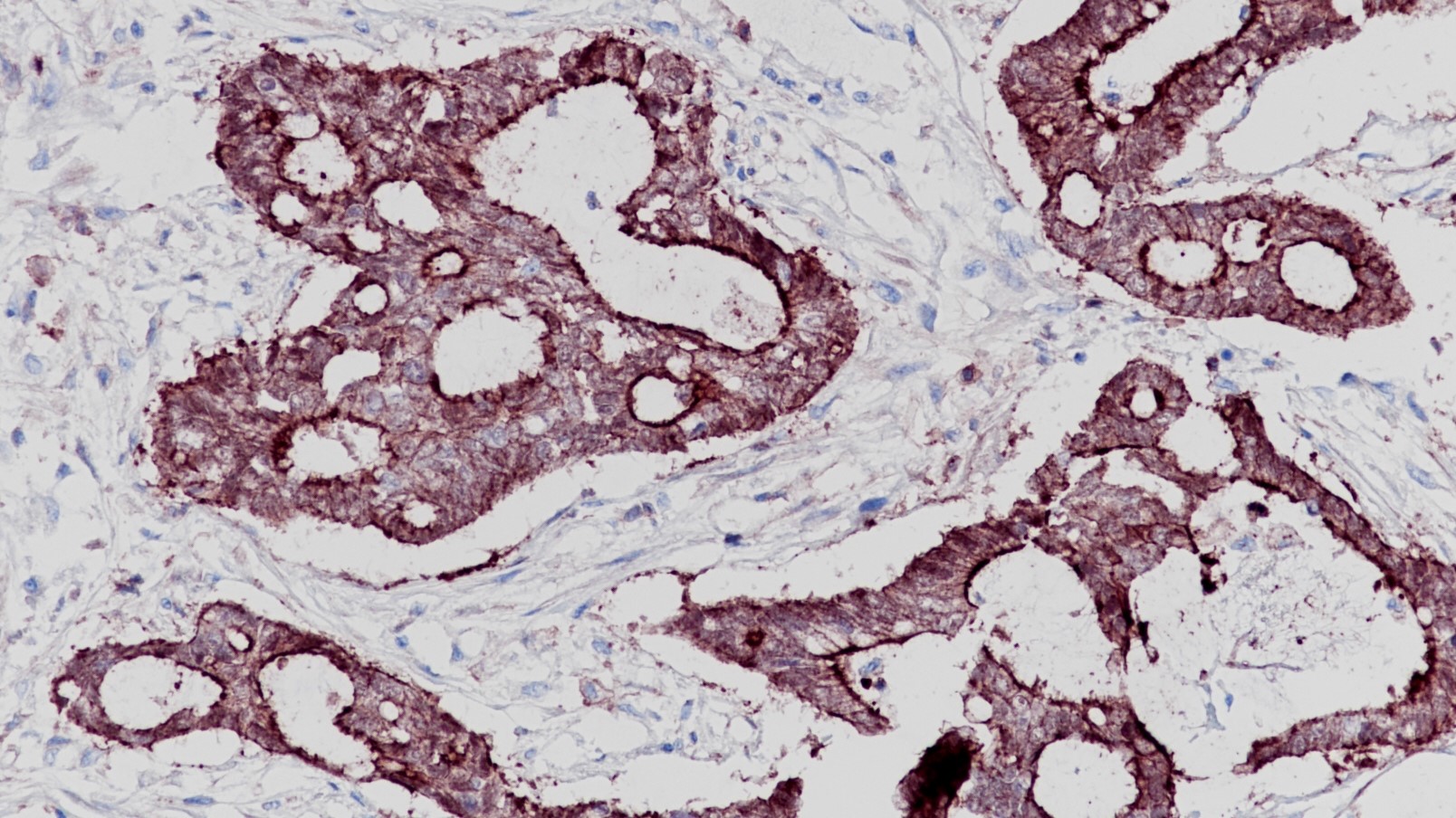 结肠腺癌Villin(BP6066)染色